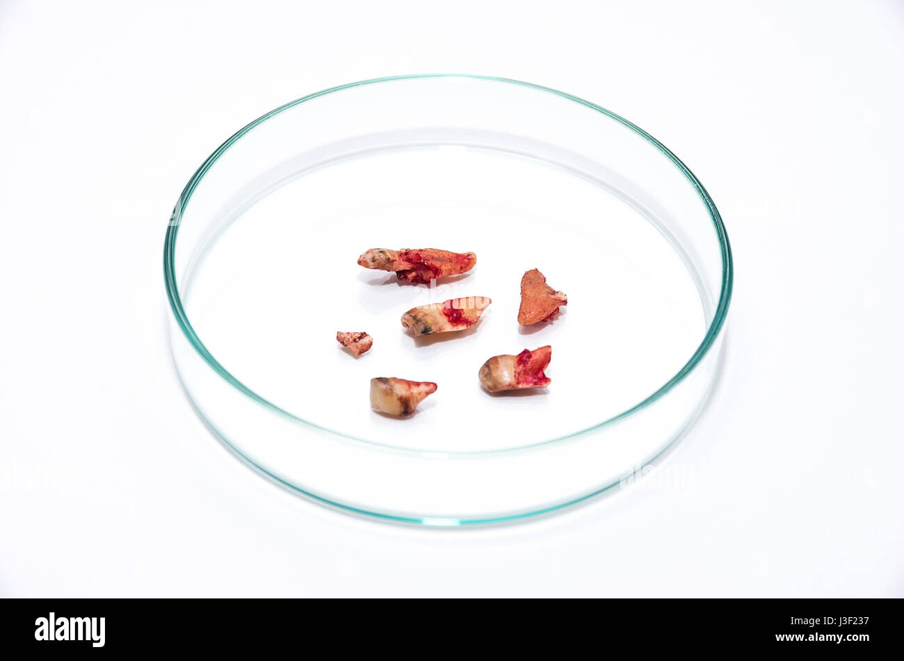 Des fragments d'une dent humaine après extraction dans une boîte de pétri. Banque D'Images