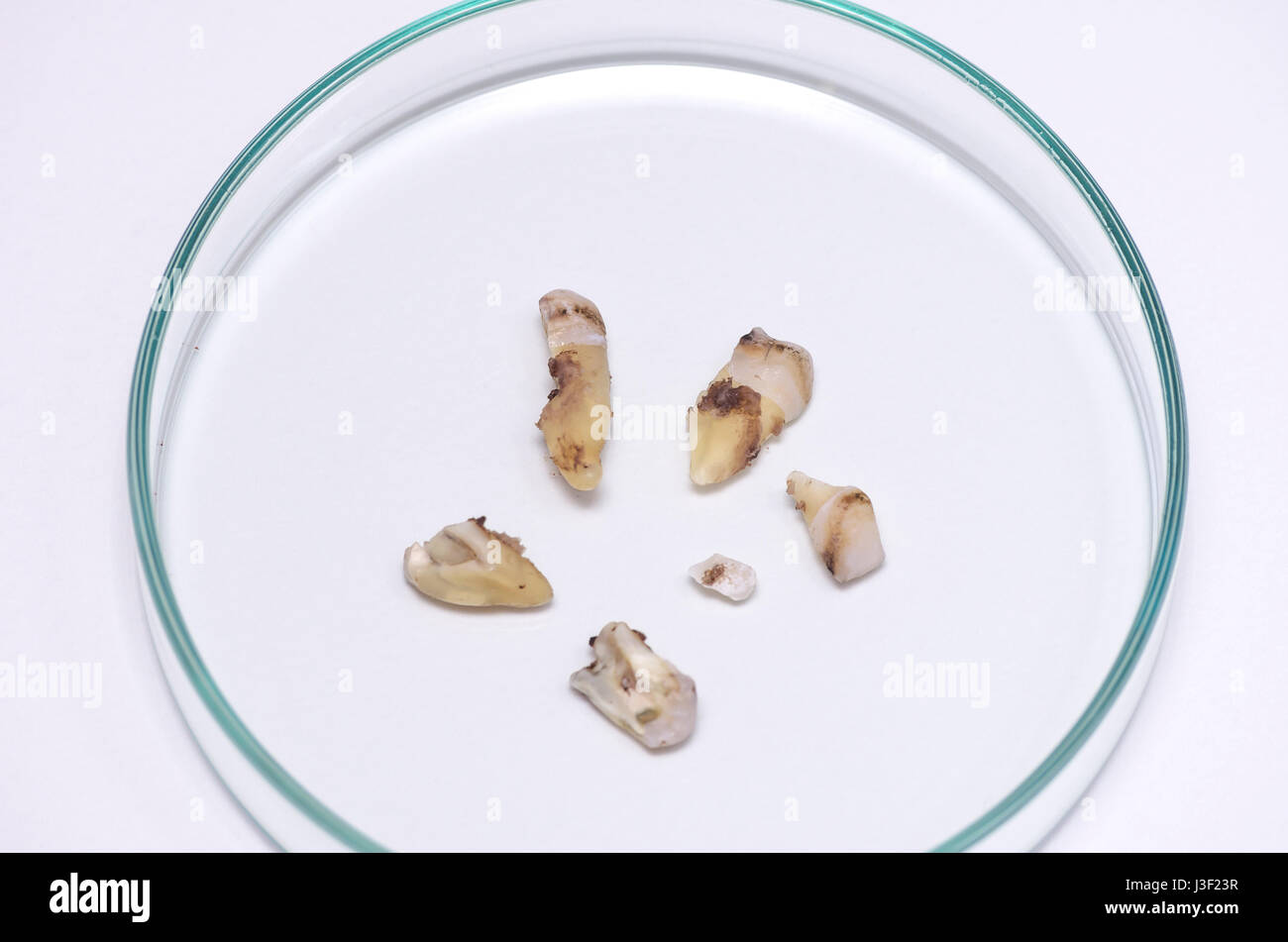 Des fragments d'une dent humaine après extraction dans une boîte de pétri. Banque D'Images