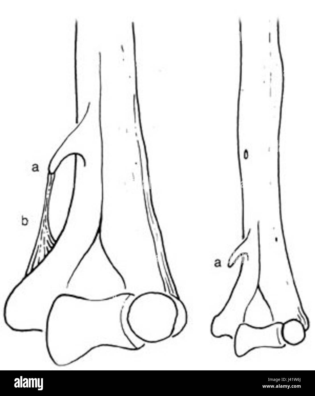 Le ligament de Struthers est une caractéristique anatomique rare qui peut être trouvée chez certains individus, souvent étudiée en anatomie médicale pour sa relation avec le mouvement du bras et certaines conditions dans le membre supérieur. Banque D'Images