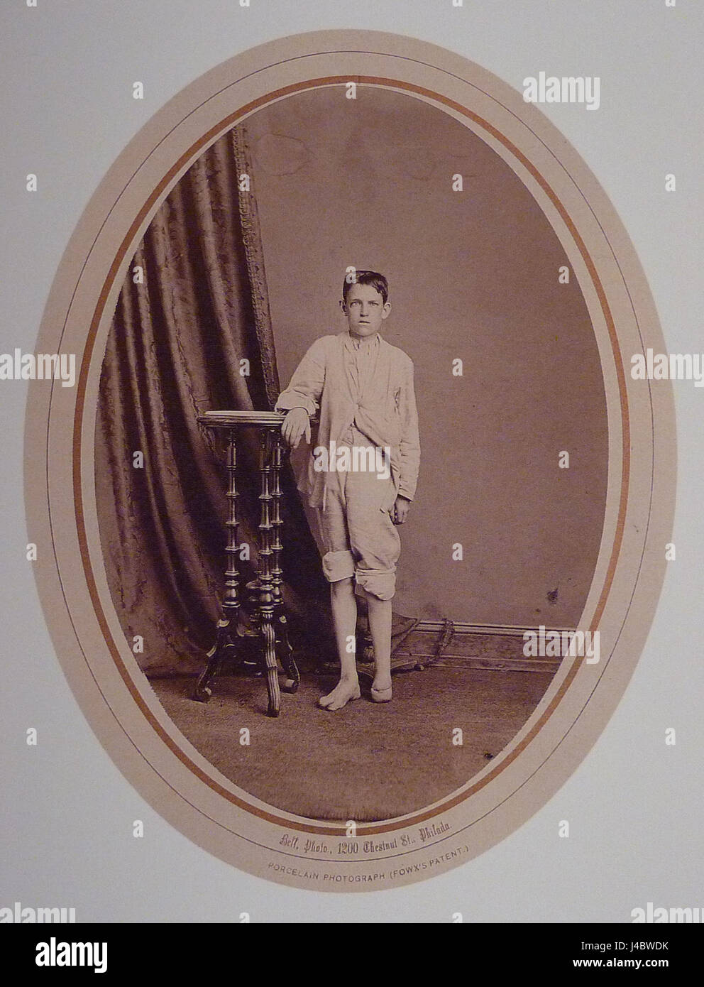 L'amputation de Pirogoff est une intervention chirurgicale lancée par le chirurgien russe Nikolai Pirogoff au XIXe siècle. Elle implique l'ablation de l'articulation du pied ou de la cheville et l'amputation de la jambe, un progrès significatif dans les techniques chirurgicales. Banque D'Images