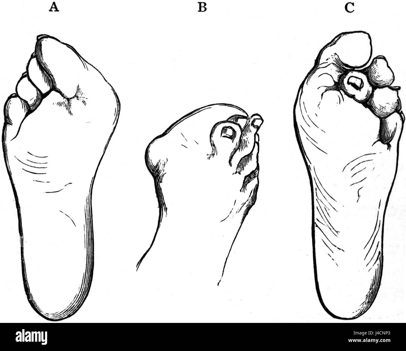 L'image de PSM V17 D759 illustre les effets nocifs de chaussures mal formées sur les pieds, démontrant des déformations causées par une conception médiocre des chaussures, comme observé dans les études médicales du début du XXe siècle. Banque D'Images