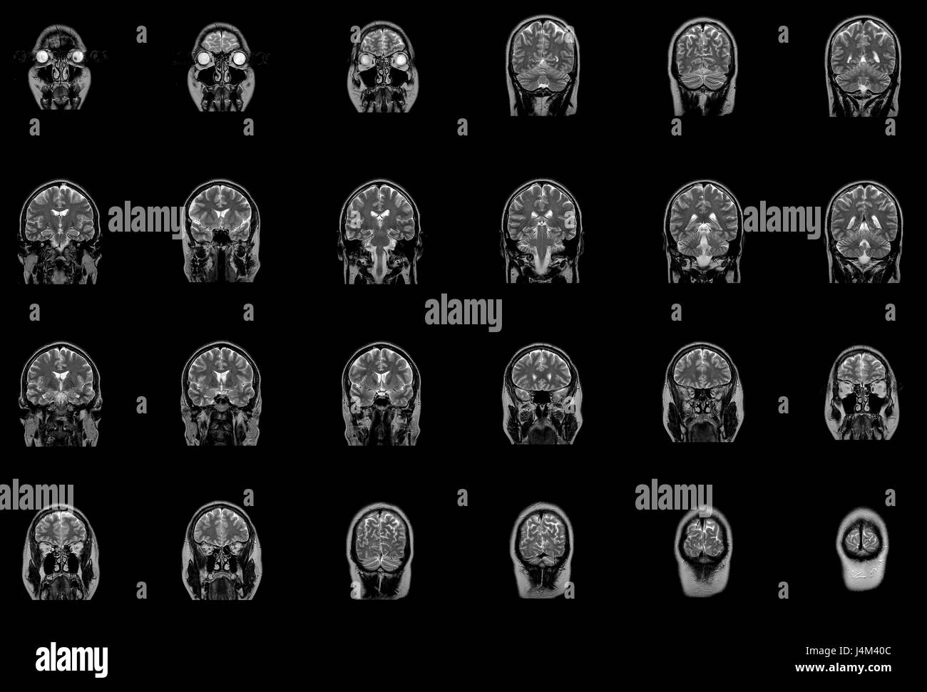 L'imagerie par résonance magnétique du cerveau et du tronc cérébral Banque D'Images