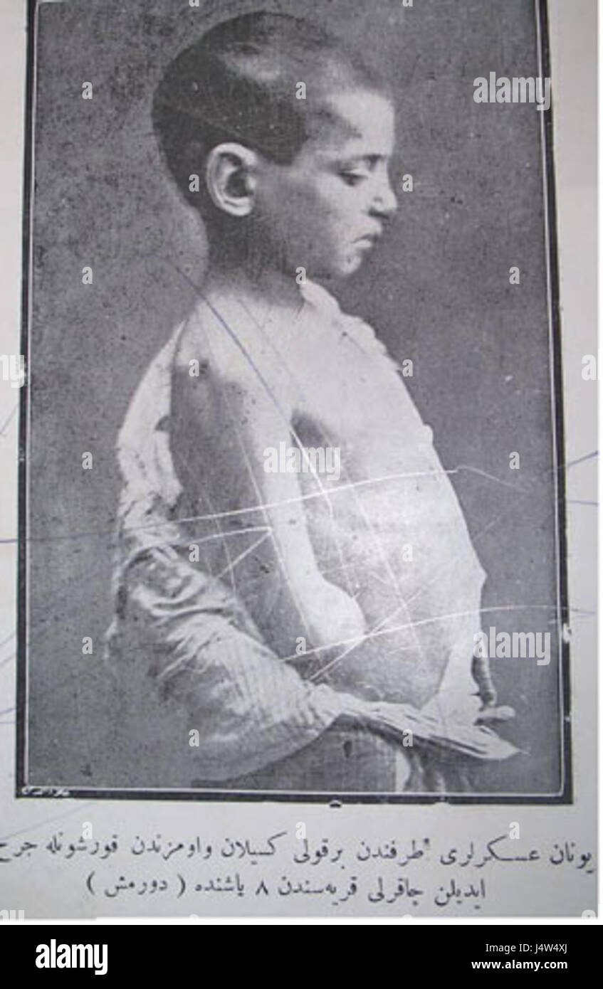 Bras de garçon turc coupées par des soldats grecs Banque D'Images