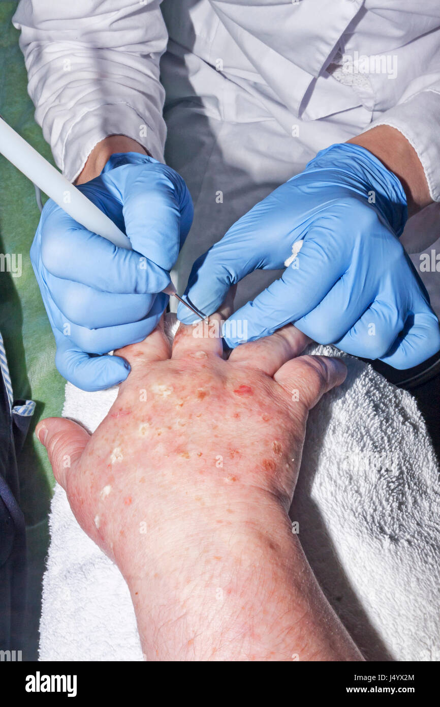 Dermatologue chirurgien élimine les maladies de peau avec electrocoagulator Banque D'Images