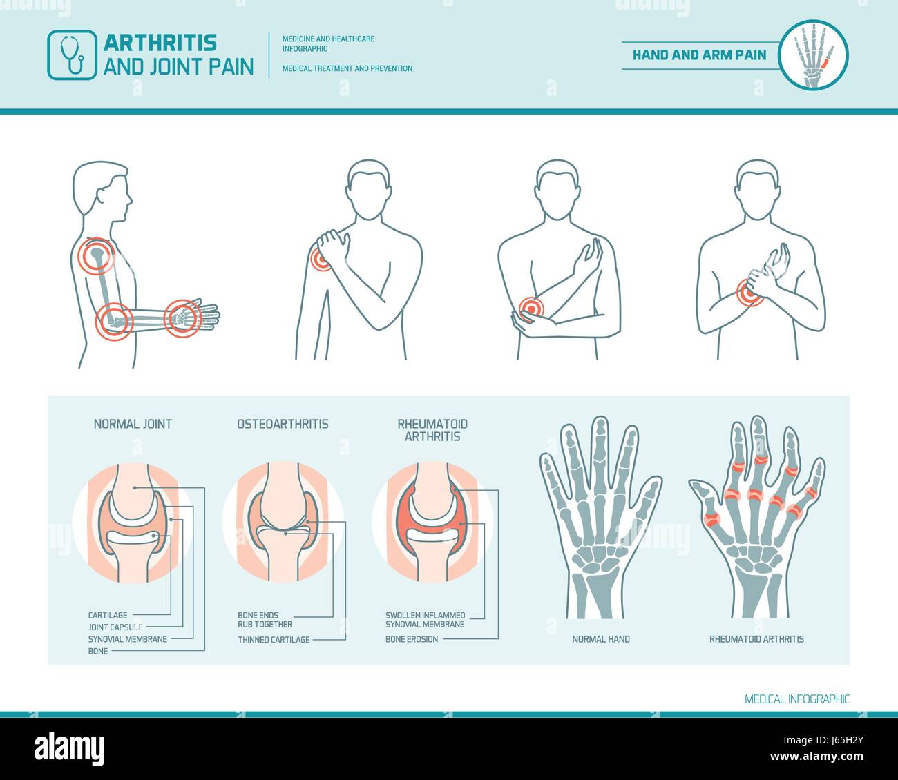 L'arthrite et la douleur commune infographie, illustration anatomique d'une main et le bras inflammées Illustration de Vecteur