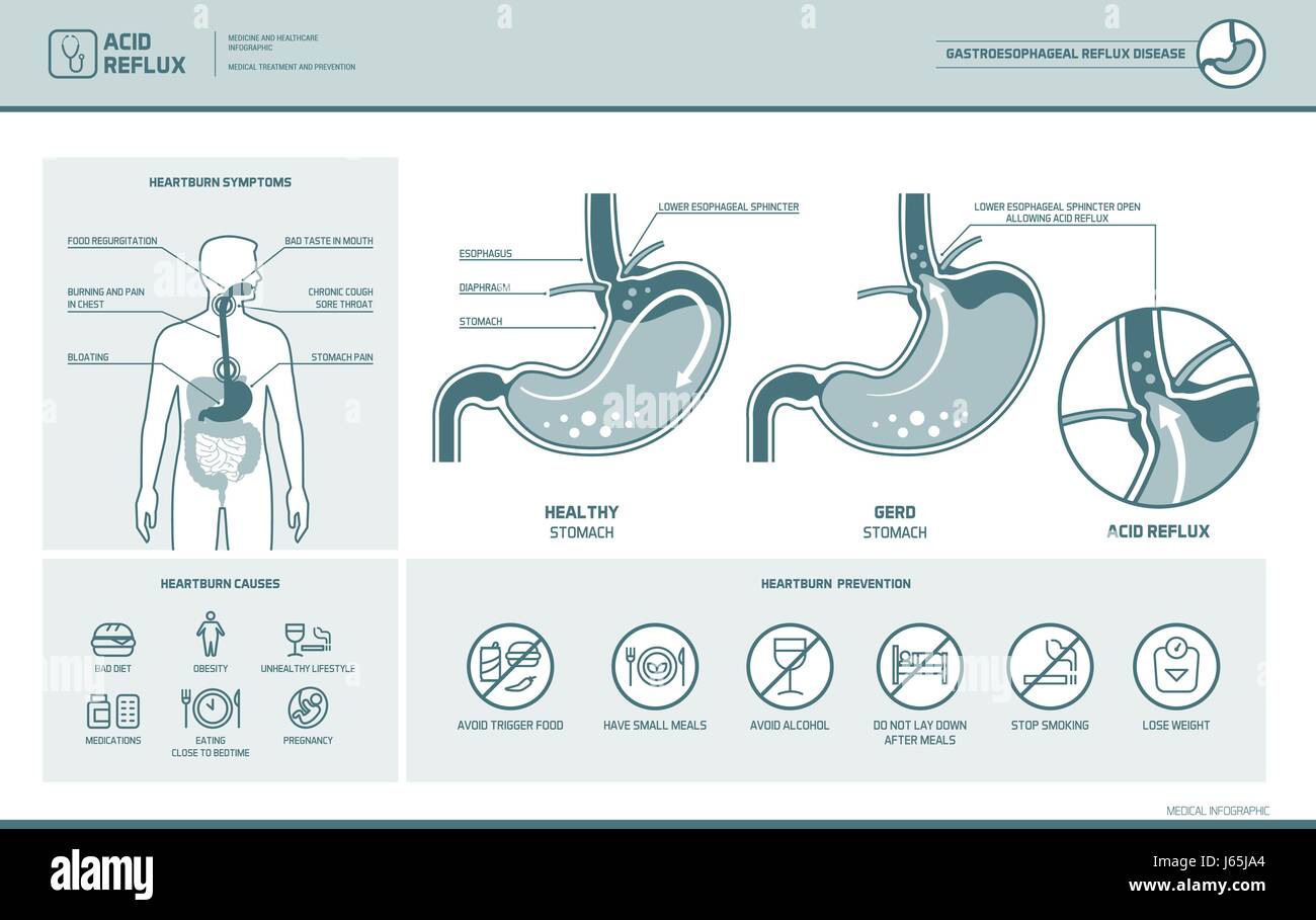 Acide reflux, brûlures d'estomac et le rgo infographie avec illustration médicale, les symptômes, causes et prévention Illustration de Vecteur Acide reflux, brûlures d'estomac et le rgo infographie avec illustration médicale, les symptômes, causes et prévention Illustration de Vecteur