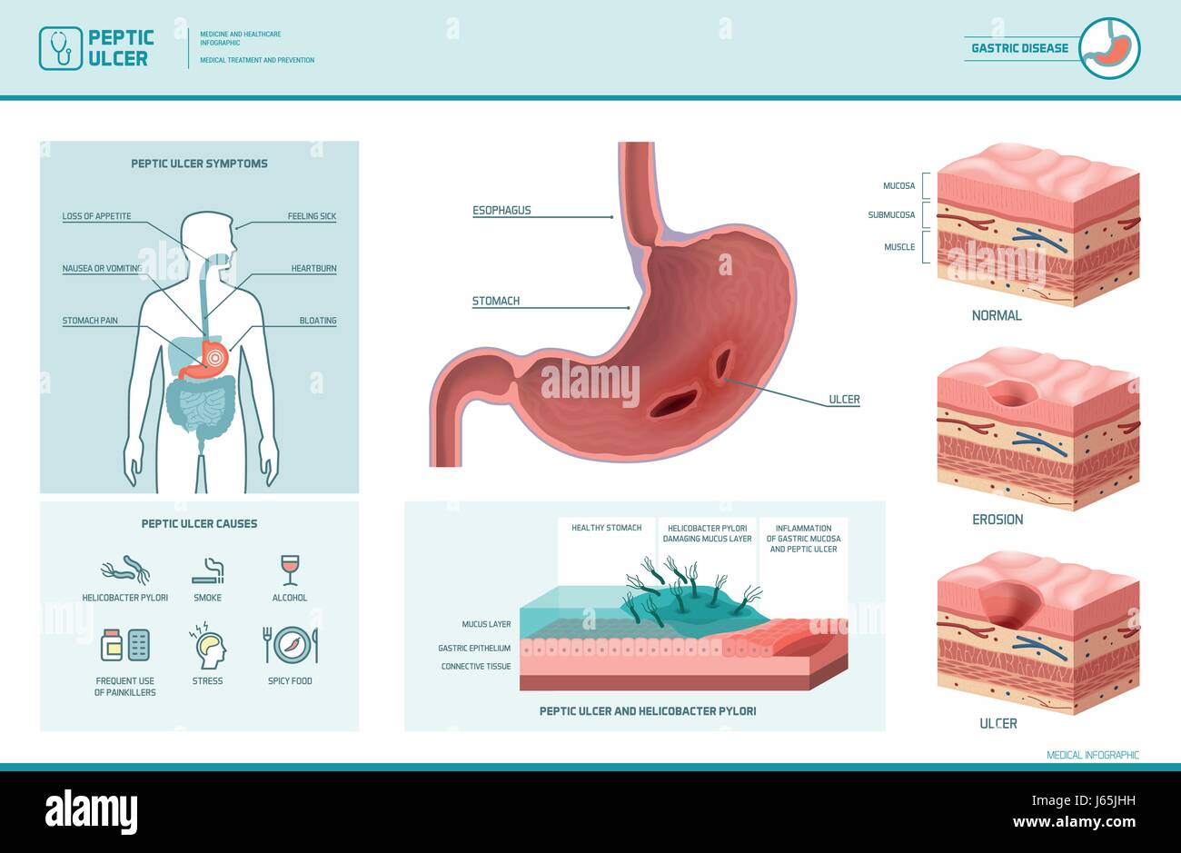 L'ulcère gastrique et helicobacter pylori infographie avec des symptômes et causes de l'estomac, diagramme de la coupe transversale, illustration médicale Illustration de Vecteur