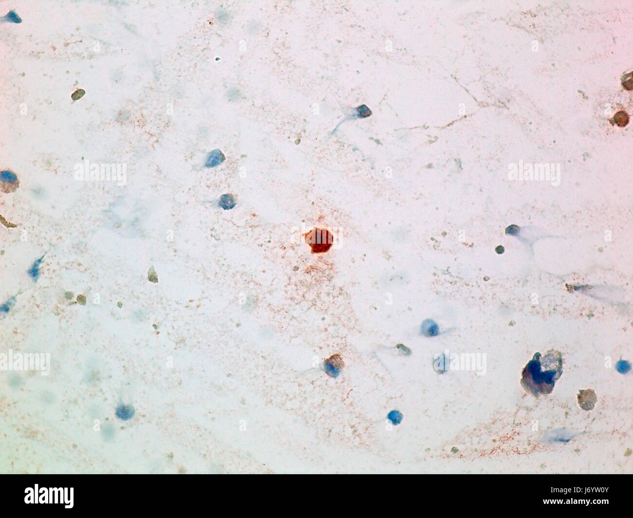 Les macrophages chargés de lipides en cytologie de lavage bronchoalvéolaire Vue à 400x de grossissement avec le Soudan III la coloration. Banque D'Images