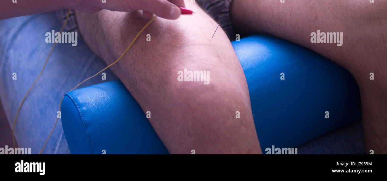 Clinique de physiothérapie physiothérapie mecical EPI acupunture aiguille sèche traitement pour blessure à la jambe de la réadaptation. Banque D'Images