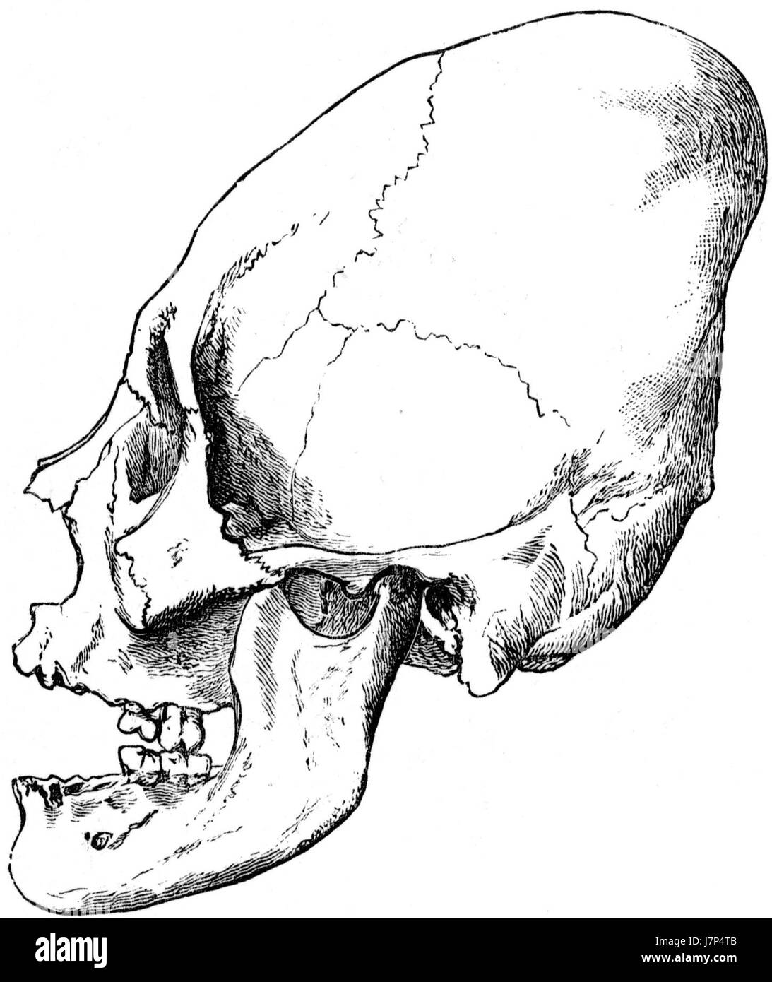 Le crâne artificiellement aplati d'un ancien individu péruvien représente une pratique culturelle parmi les sociétés précolombiennes des Andes. Cette pratique, impliquant la déformation du crâne, a souvent été pratiquée pour des raisons esthétiques, spirituelles ou sociales et donne un aperçu de la culture andine antique. Banque D'Images
