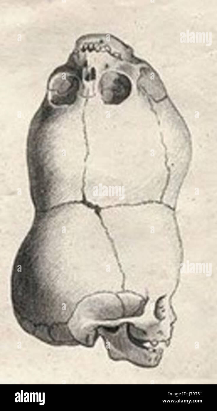 CraniopagusParasiticus Banque D'Images