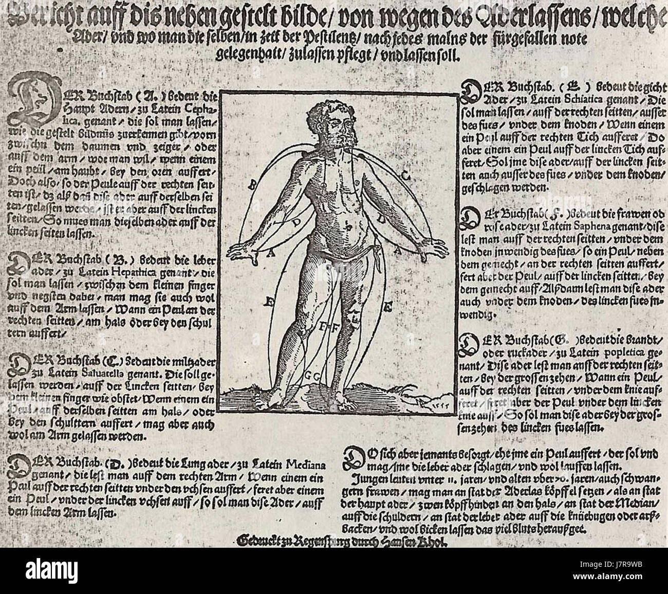 Aderlasspest fait référence à la peste sanglante, un phénomène historique en Europe au moyen âge où la saignée comme traitement médical a entraîné une mortalité importante due à la propagation des infections. Banque D'Images