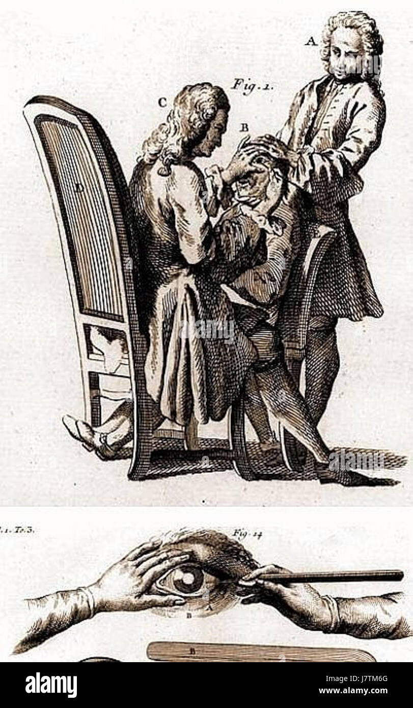 Cette entrée fait référence à une définition ou une explication de la chirurgie de la cataracte trouvée dans le 'Dictionnaire universel', un dictionnaire général. Il décrit les procédures et les termes clés associés à la chirurgie d'ablation de la cataracte. Banque D'Images