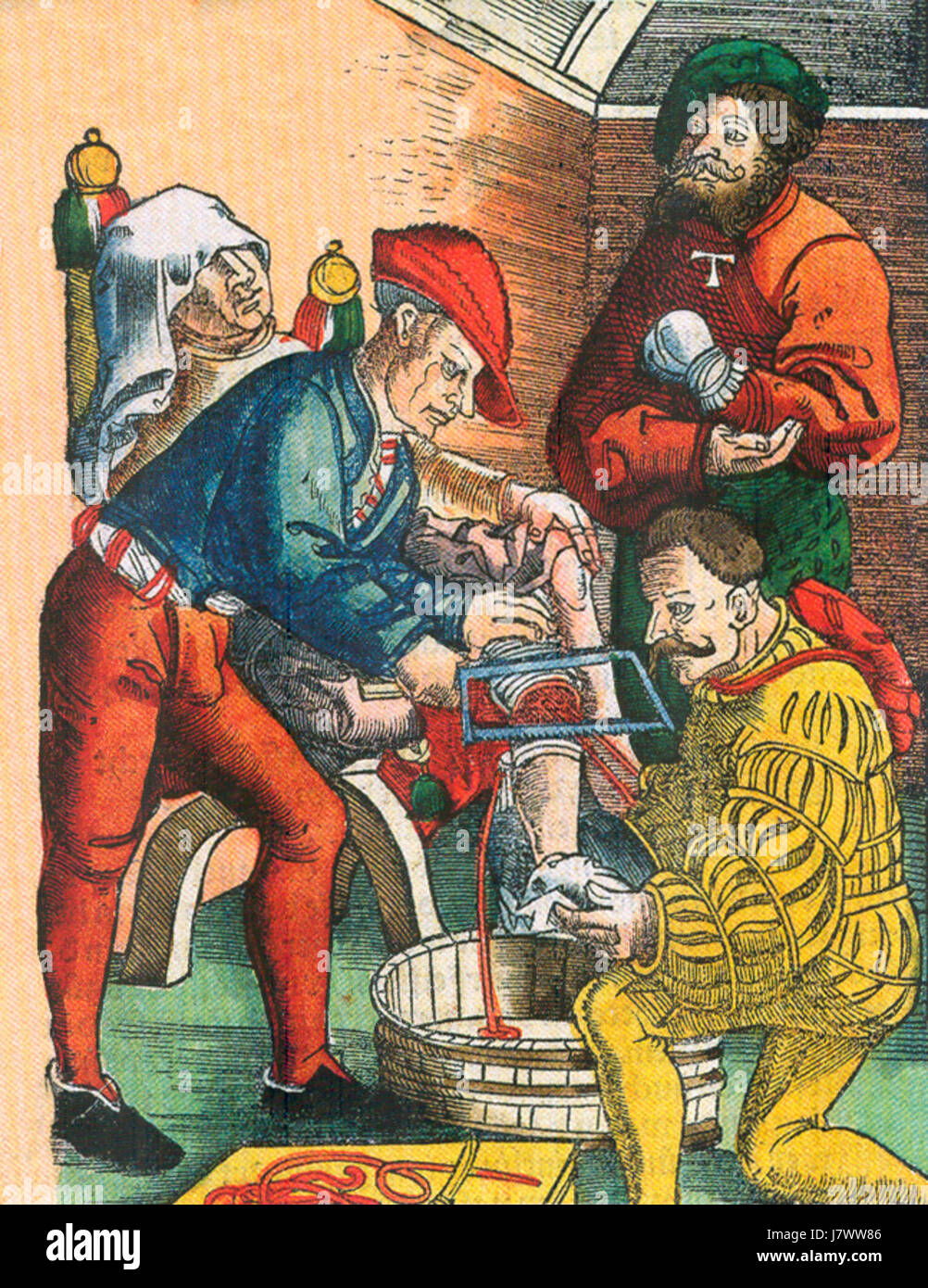 Il s'agit d'une illustration médicale ou d'une référence datant de 1540 décrivant la pratique de l'amputation, une procédure médicale courante au début de la période moderne, en particulier dans le traitement des blessures et des infections. Banque D'Images