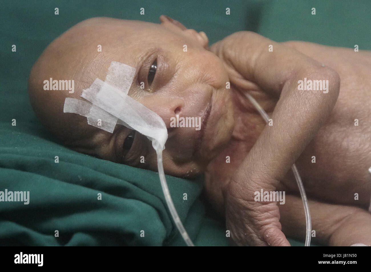 Dhaka Bangladesh 27 Mai 17 Un Bebe Est Ne Au Bangladesh Medical College Hospital Il Y A 4 Jours Avec Une Maladie Genetique Tres Rare Appelee Progeria Cet Enfant Progresse Depuis Sa Dhaka Bangladesh 27 Mai 17 Un Bebe Est Ne Au Bangladesh Medical College Hospital Il Y A 4 Jours Avec Une Maladie Genetique Tres Rare Appelee Progeria Cet Enfant Progresse Depuis Sa