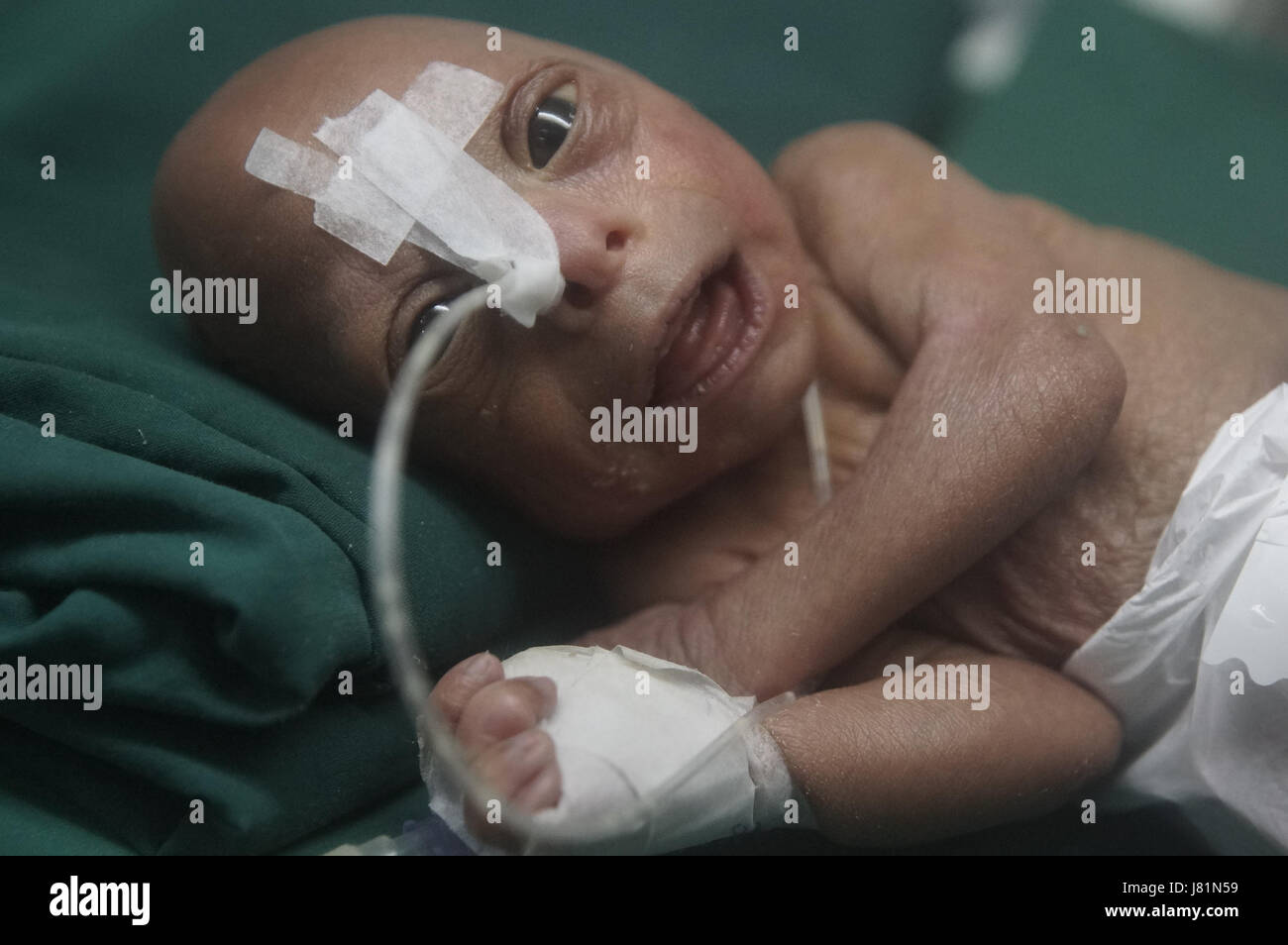 Dhaka Bangladesh 27 Mai 17 Un Bebe Est Ne Au Bangladesh Medical College Hospital Il Y A 4 Jours Avec Une Maladie Genetique Tres Rare Appelee Progeria Cet Enfant Progresse Depuis Sa Dhaka Bangladesh 27 Mai 17 Un Bebe Est Ne Au Bangladesh Medical College Hospital Il Y A 4 Jours Avec Une Maladie Genetique Tres Rare Appelee Progeria Cet Enfant Progresse Depuis Sa