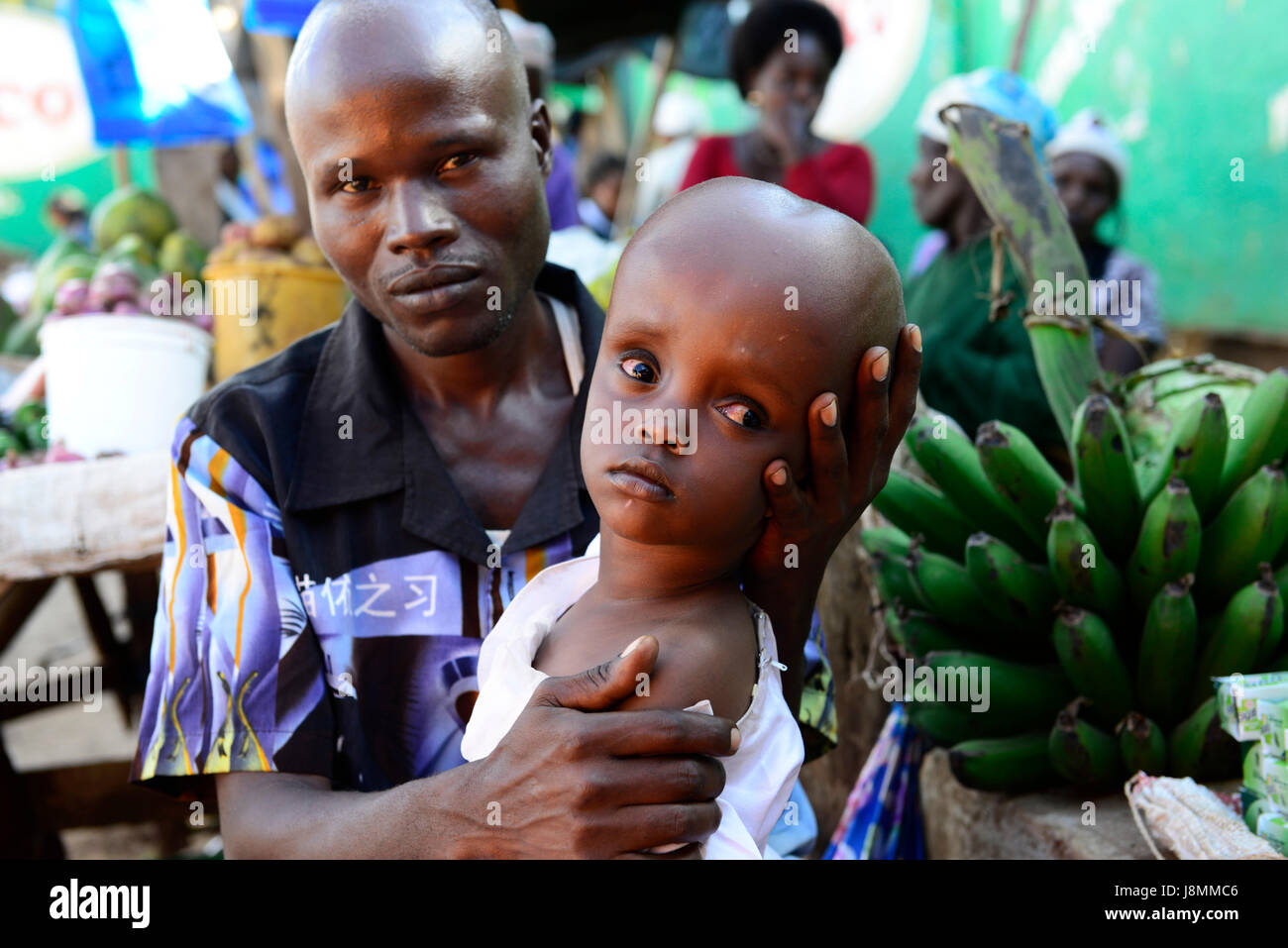 Un jeune enfant avec une hydrocéphalie état avec son père au Kenya. Banque D'Images