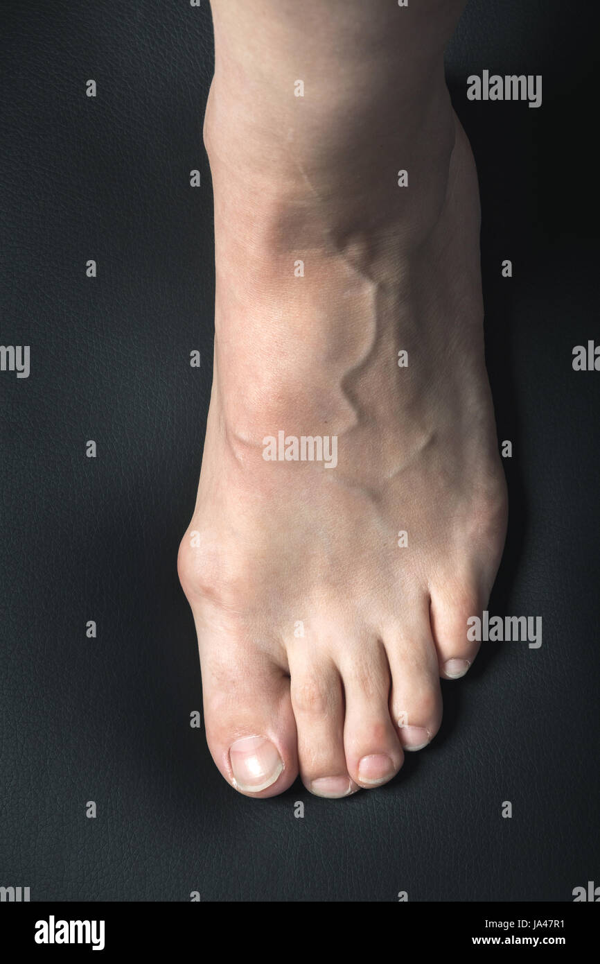 L'hallux valgus ou oignon blanc femme sur pied Banque D'Images