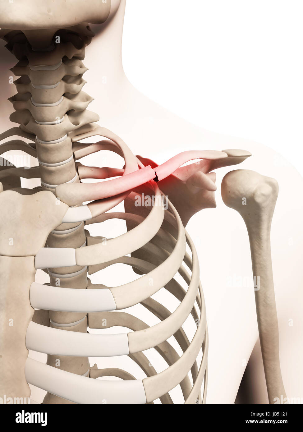 Illustration médicale d'une clavicule cassée Photo Stock Alamy