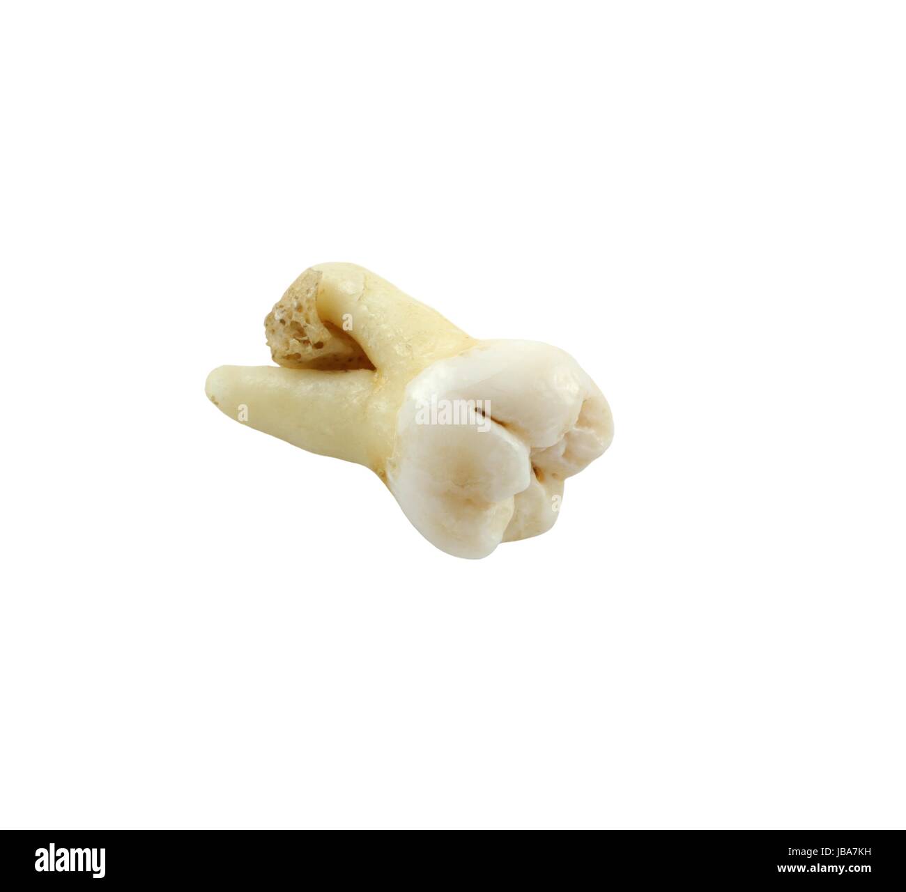 Déposer le huitième dent inférieure avec un morceau de tissu d'os sur fond blanc. dent de sagesse Banque D'Images