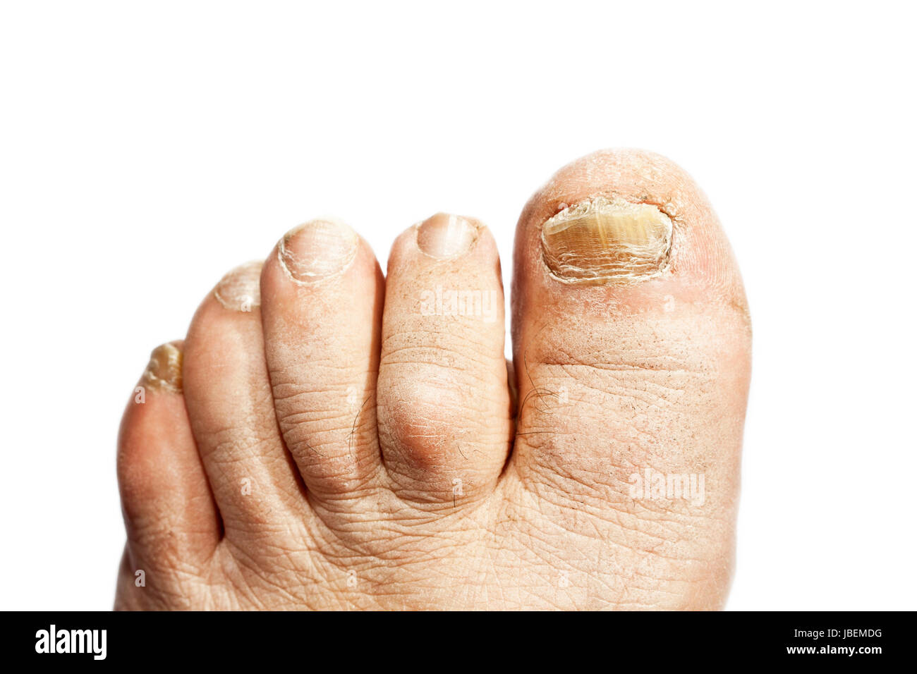 L'infection à champignon sur les ongles de pied de l'homme Banque D'Images