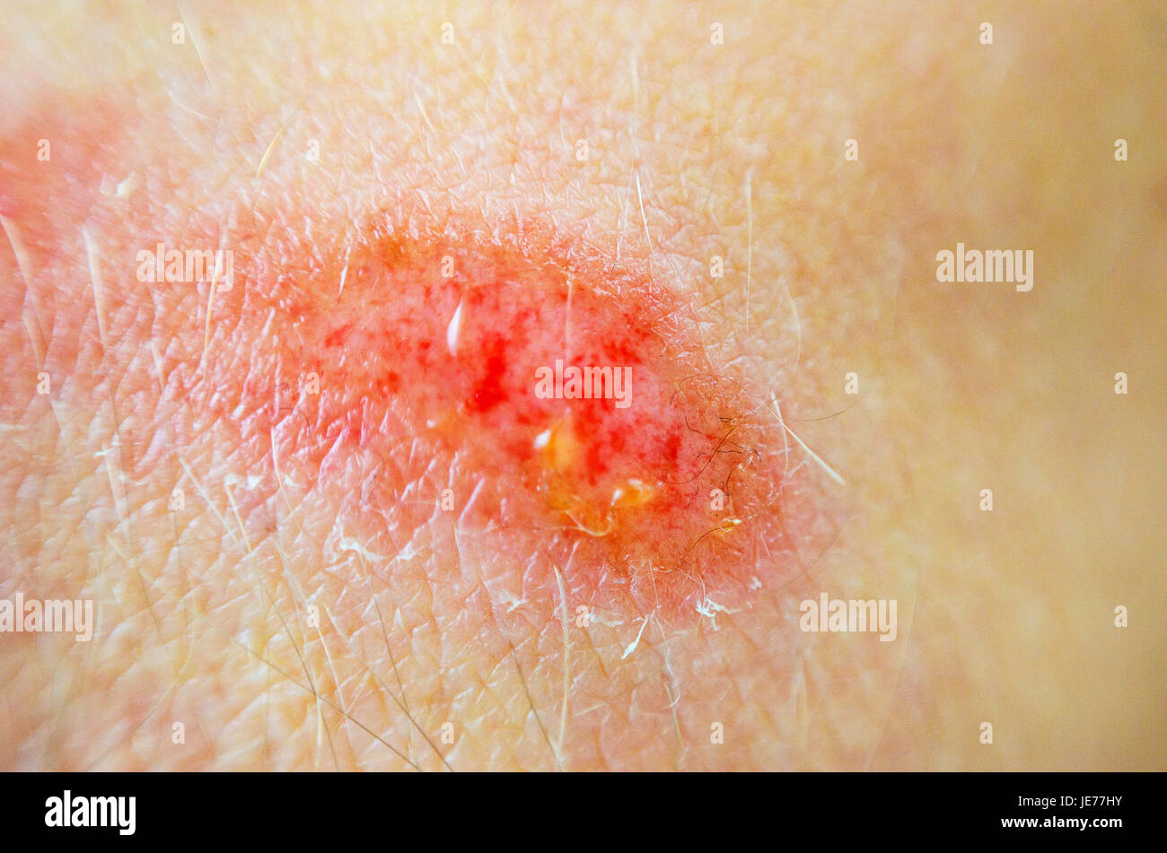 Skin abrasion Banque de photographies et d’images à haute résolution — free download