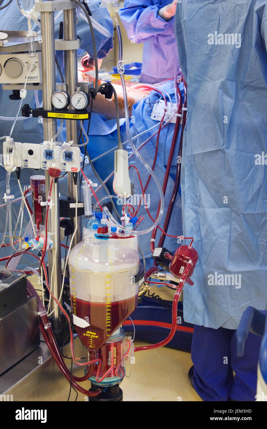 Le réservoir de la machine de perfusion de sang qui a pris en charge le coeur & fonctions pulmonaires des patients ayant un pontage aortocoronarien. Banque D'Images