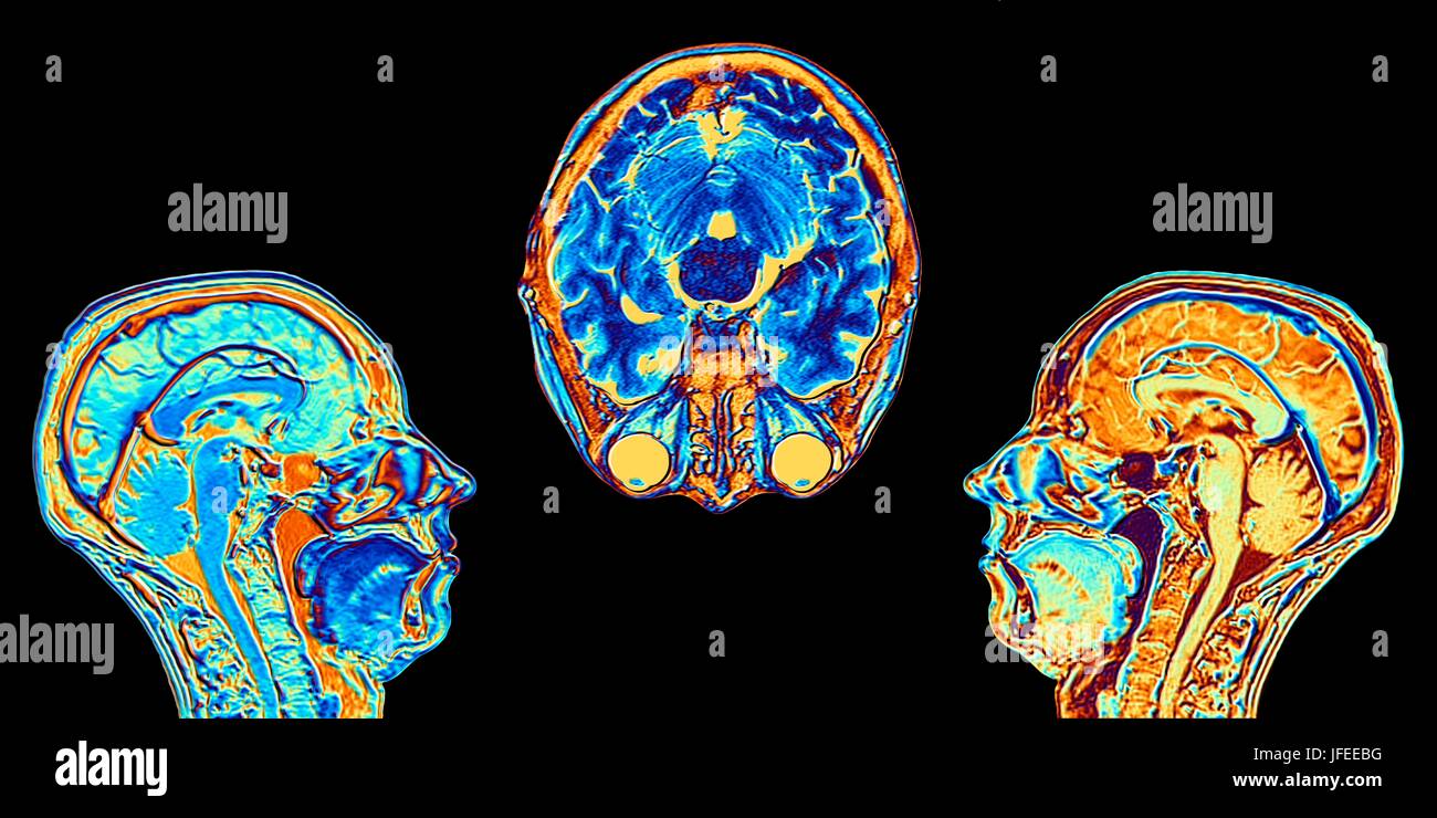 Ordinateur en fausses couleurs améliorée des images par résonance magnétique (IRM) de deux mi-sagittal et un dans l'axe (vue en coupe) sections à travers la tête d'une normale 46 ans, femme, montrant les structures du cerveau, de la colonne vertébrale et les tissus du visage. Caractéristiques Profil de la partie principale du cerveau : l'alambiqué surface du cortex cérébral, le corps calleux, pons & medulla, structures du tronc cérébral, qui sont en continuité avec la moelle épinière. Le cervelet, le centre de l'équilibre et coordination, se trouve à droite du tronc cérébral. Banque D'Images