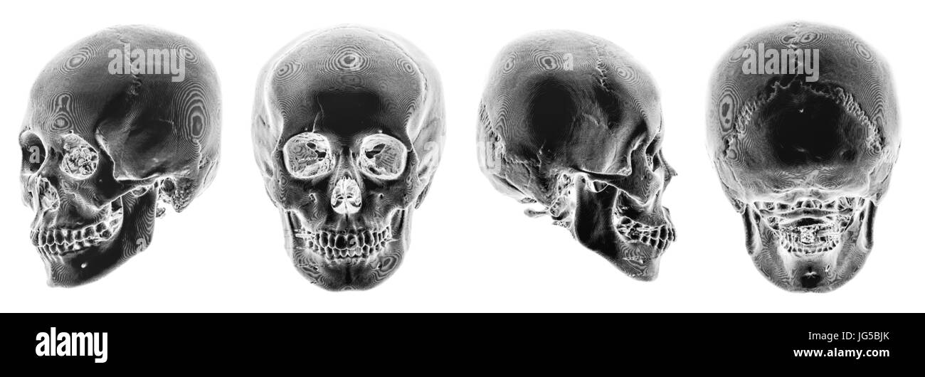 Scanner 3D de crâne humain . Plusieurs avis . Style couleur Inverser . Banque D'Images
