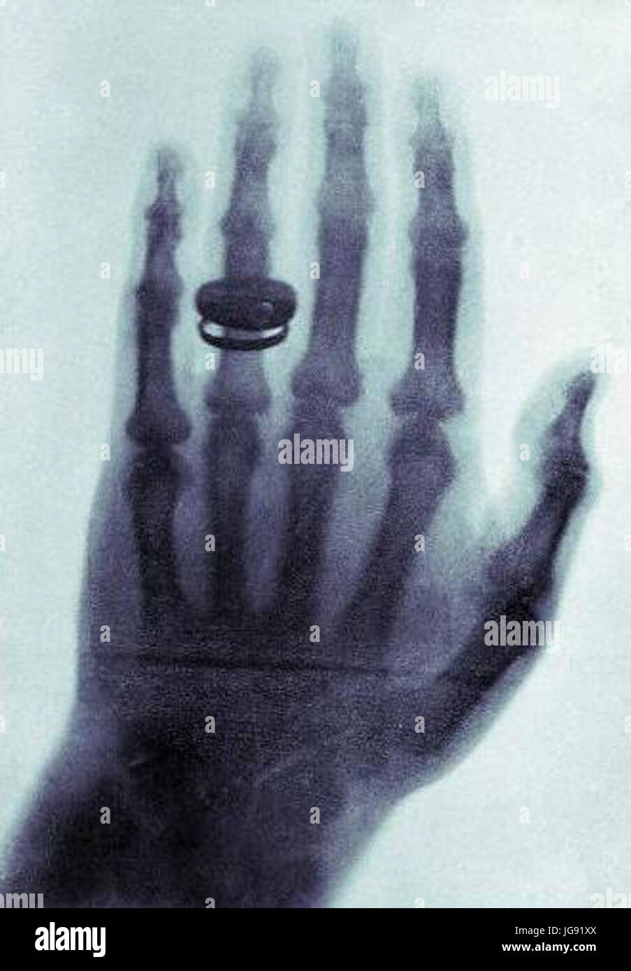 X-ray par Wilhelm Röntgen d'Albert von Kölliker s part - 18960123-01 Banque D'Images