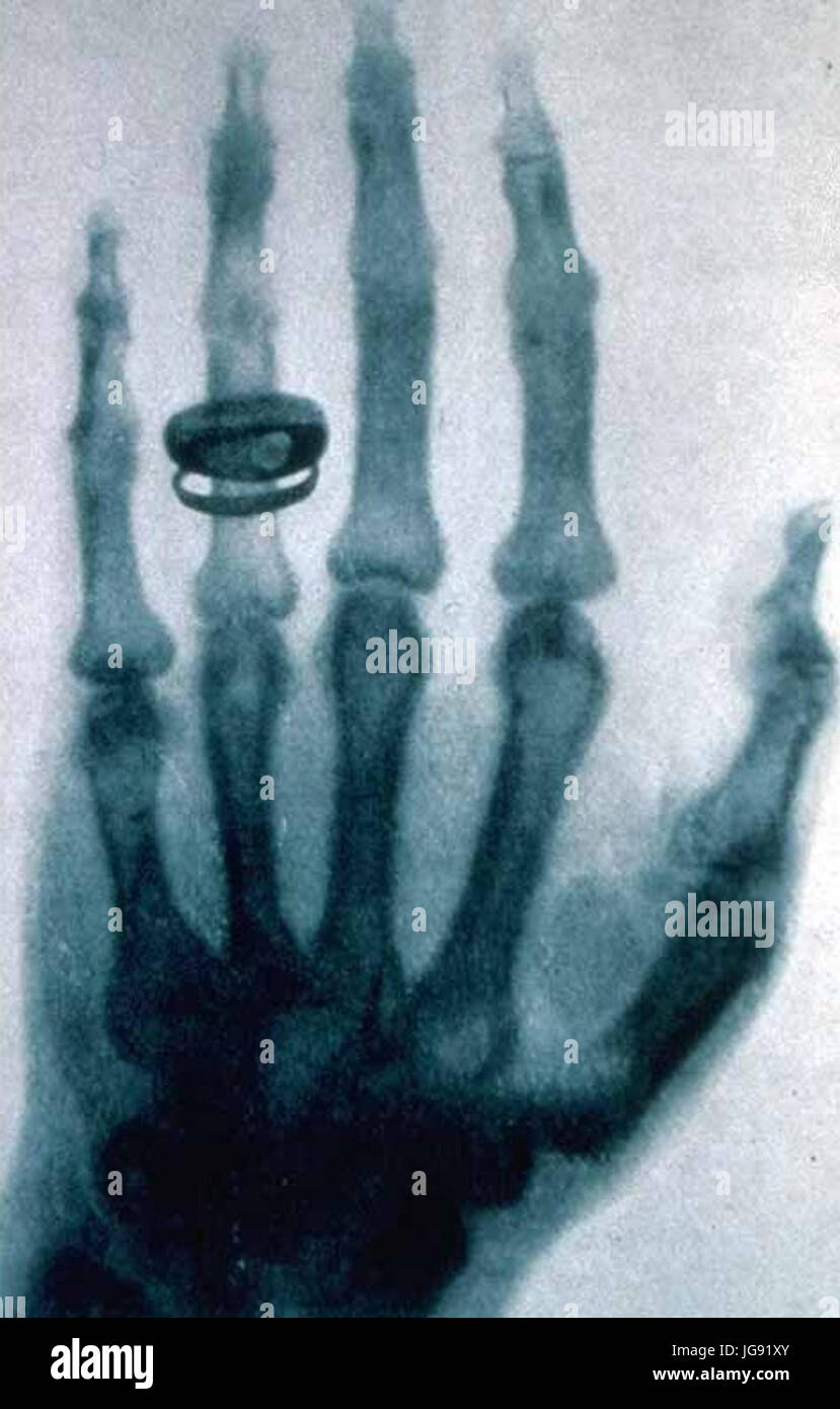 X-ray par Wilhelm Röntgen d'Albert von Kölliker's hand - 18960123-02 Banque D'Images