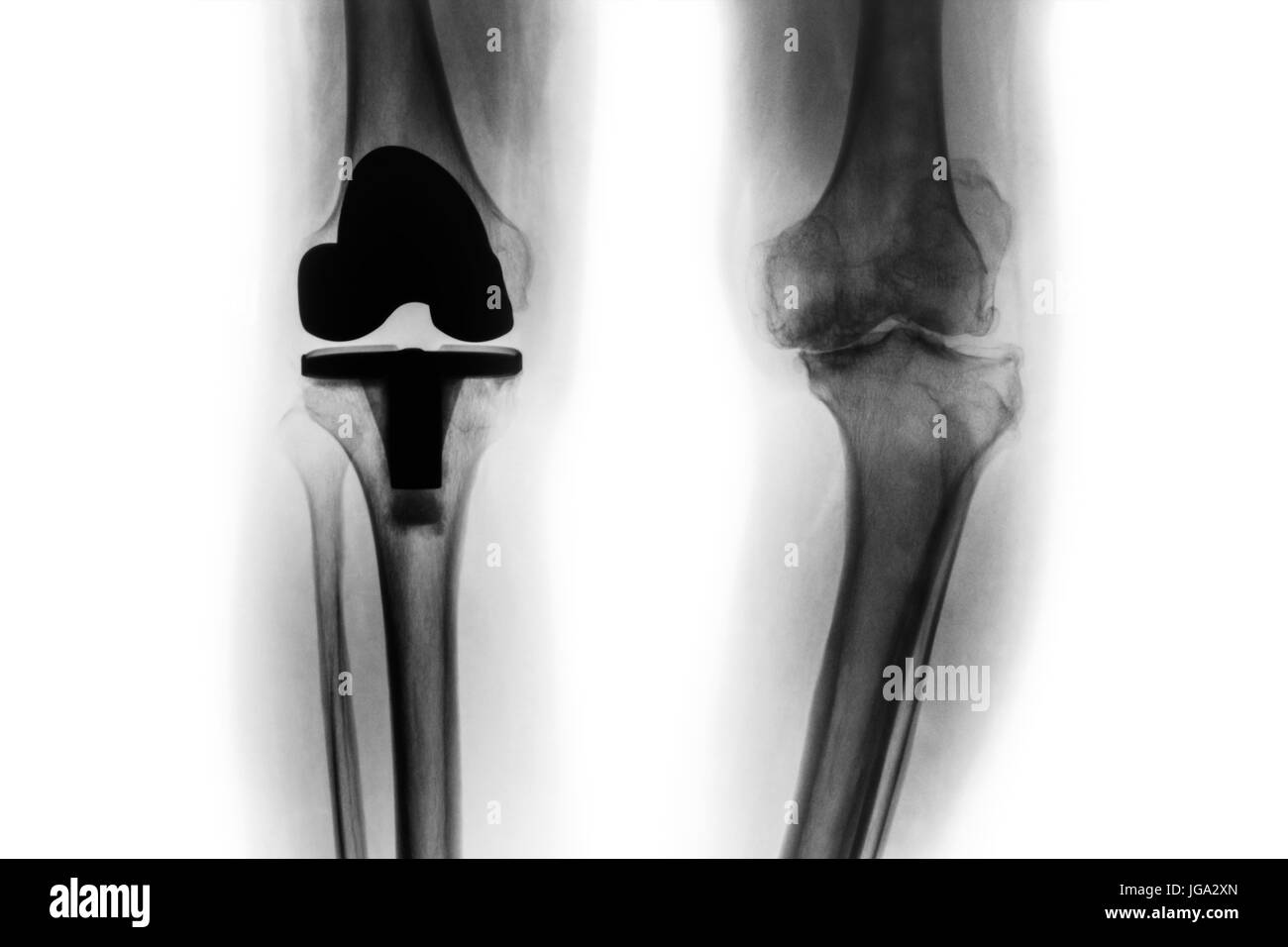 Film x-ray de l'arthrose du genou et patient articulation artificielle ( un remplacement total du genou ) . Fond isolé . Banque D'Images