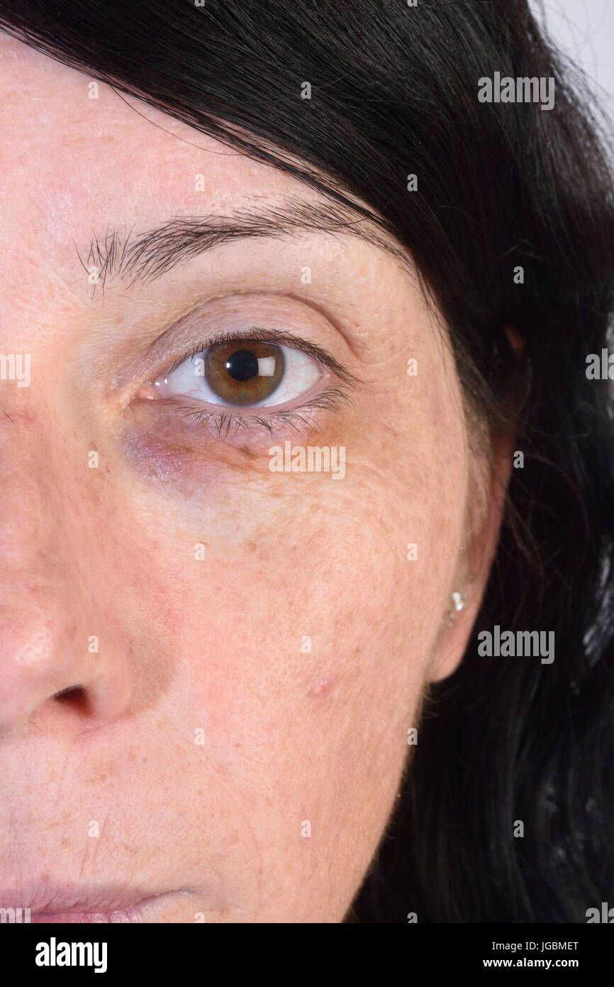 Bleu sur a woman's eye Banque D'Images