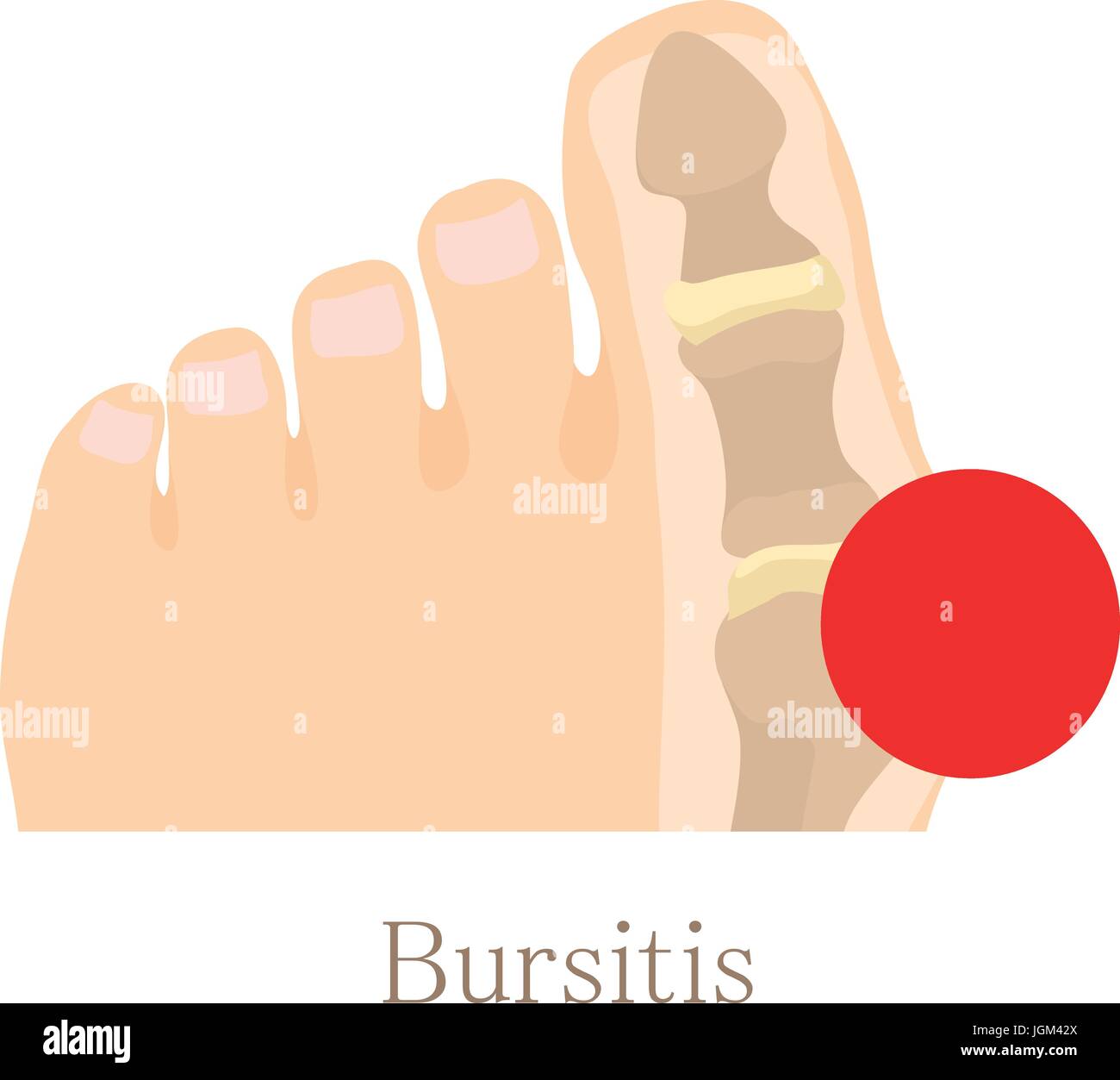 Le bursitis, icône de style cartoon Illustration de Vecteur