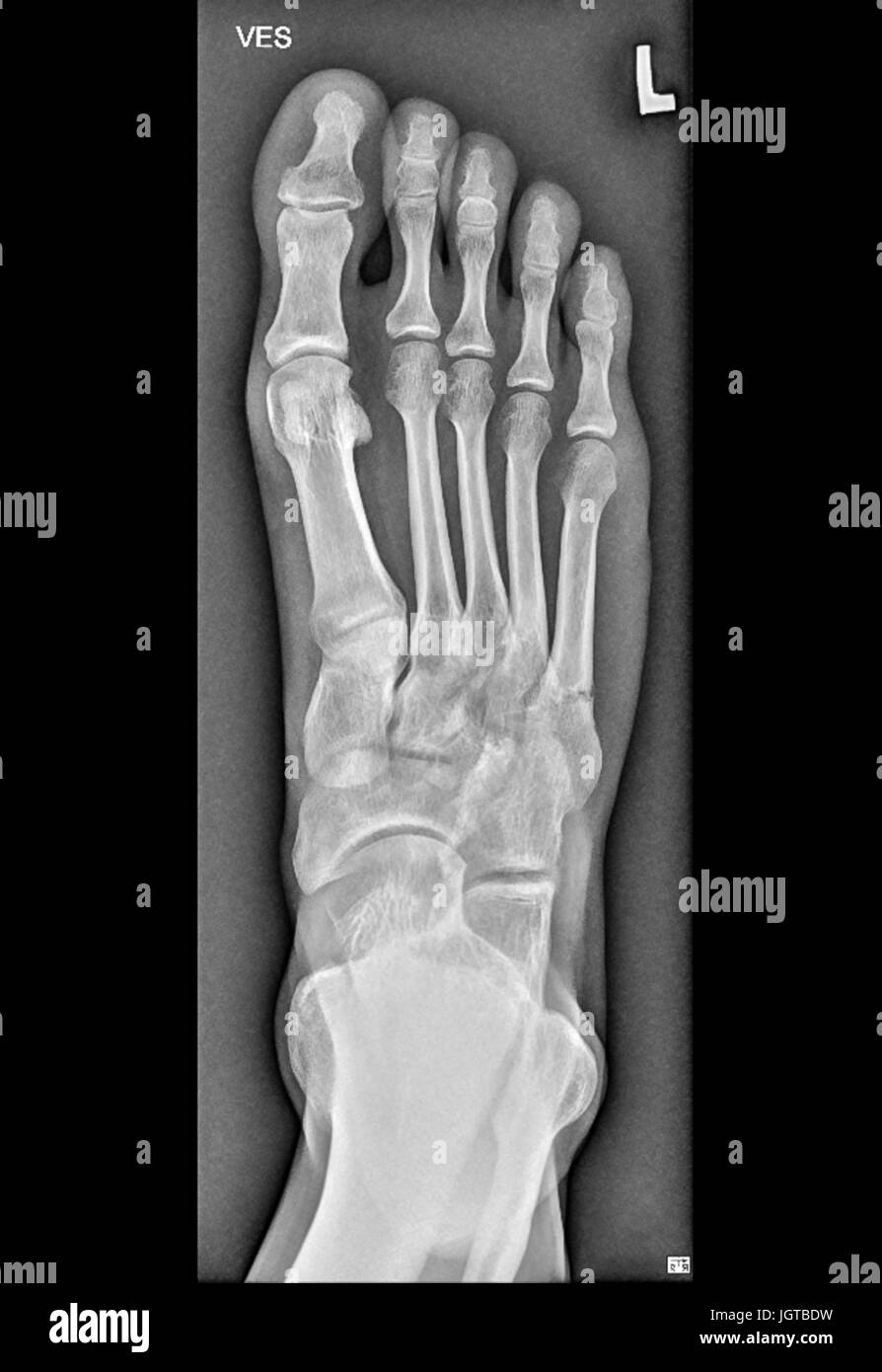 Pied Medical Xray Os Casse Le Traitement Des Patients Photo Stock Alamy Pied Medical Xray Os Casse Le Traitement Des Patients Photo Stock Alamy
