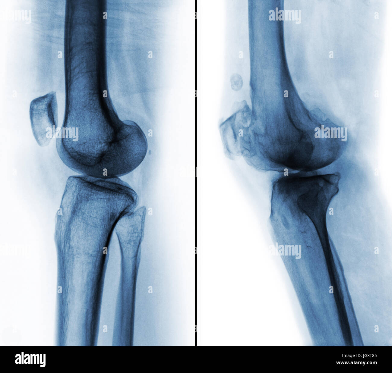 Comparaison entre le genou humain normal ( image de gauche ) et de l'arthrose du genou ( image de droite ) . Vue latérale . Banque D'Images