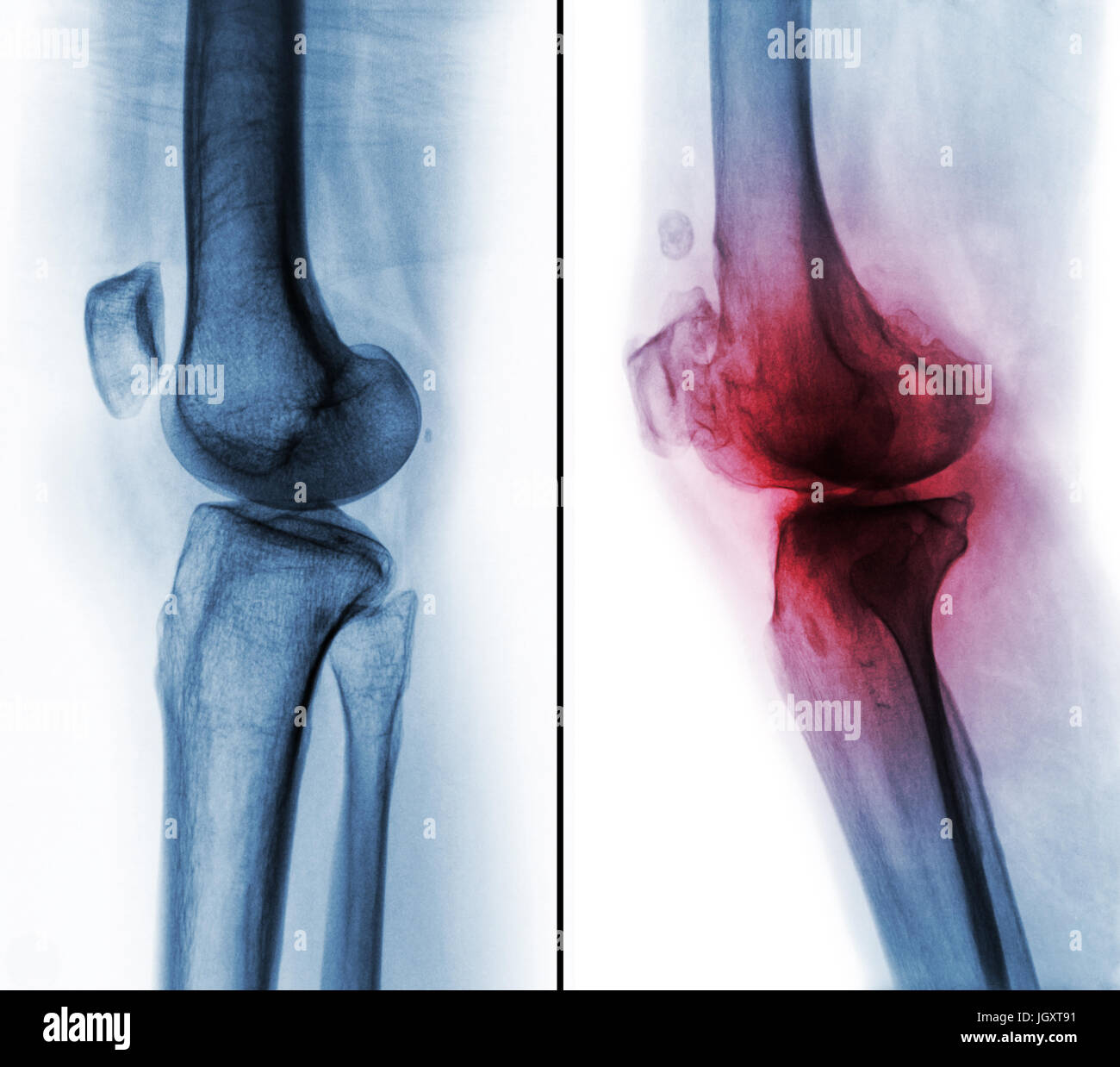 Comparaison entre le genou humain normal ( image de gauche ) et de l'arthrose du genou ( image de droite ) . Vue latérale . Banque D'Images