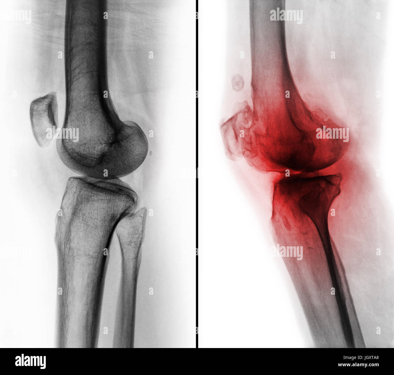 Comparaison entre le genou humain normal ( image de gauche ) et de l'arthrose du genou ( image de droite ) . Vue latérale . Banque D'Images