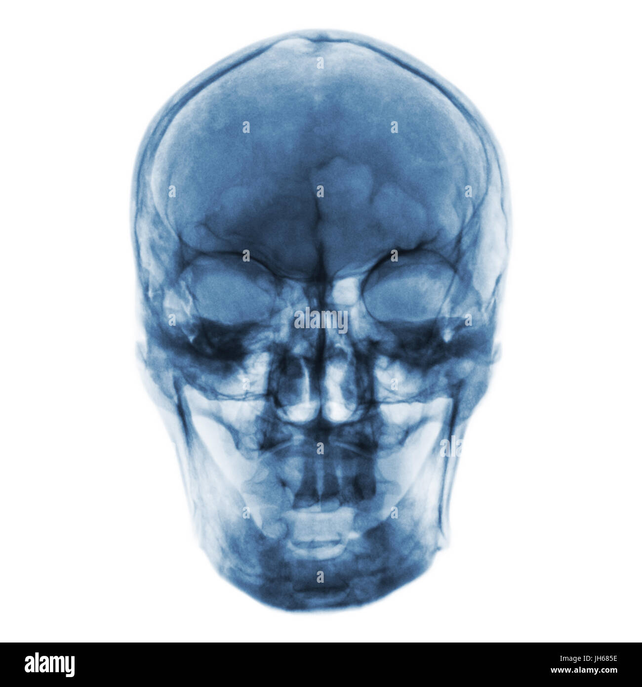 Film x-ray de crâne humain normal . Vue de face . Banque D'Images