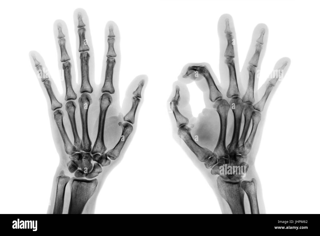 X - Ray les deux mains avec OK . Banque D'Images