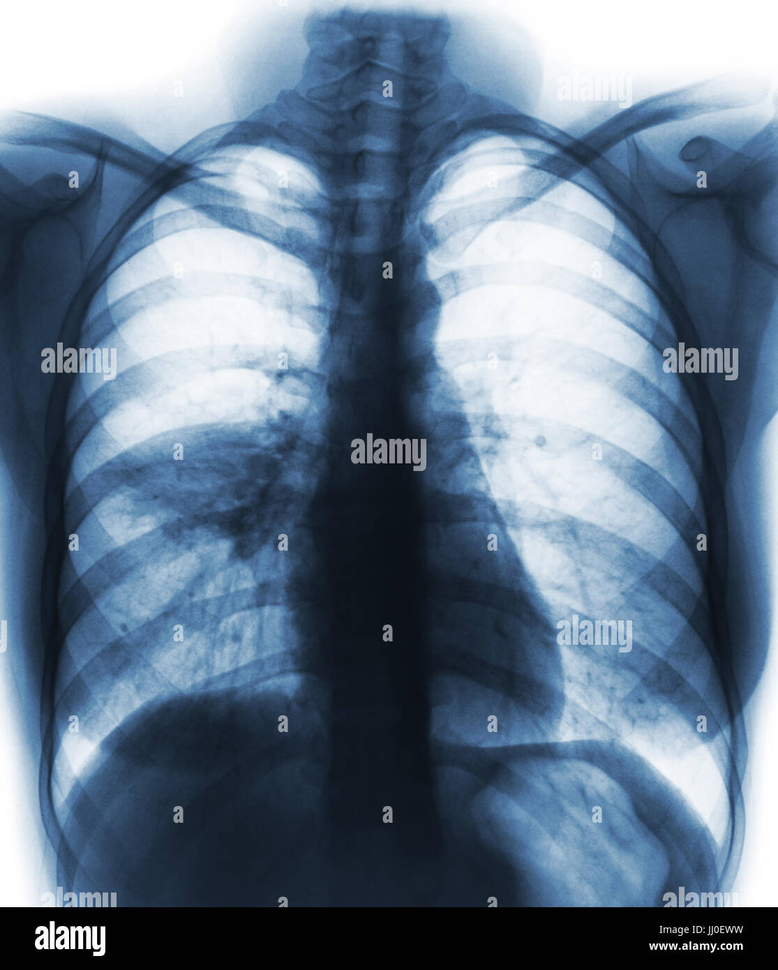 La pneumonie ( film radiographie de la montrer à infiltrer alvéolaire pulmonaire moyen droit ) ( image de la tuberculose pulmonaire . Mers-CoV . Le SRAS ) Banque D'Images