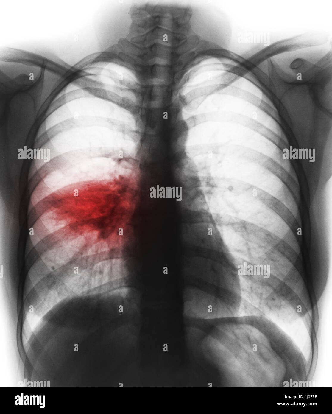 La pneumonie ( film radiographie de la montrer à infiltrer alvéolaire pulmonaire moyen droit ) ( image de la tuberculose pulmonaire . Mers-CoV . Le SRAS ) Banque D'Images