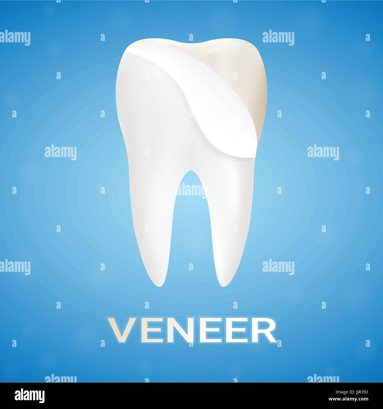 Les facettes dentaires sur une dent humaine isolée sur un arrière-plan. Vector Illustration réaliste. Illustration de Vecteur