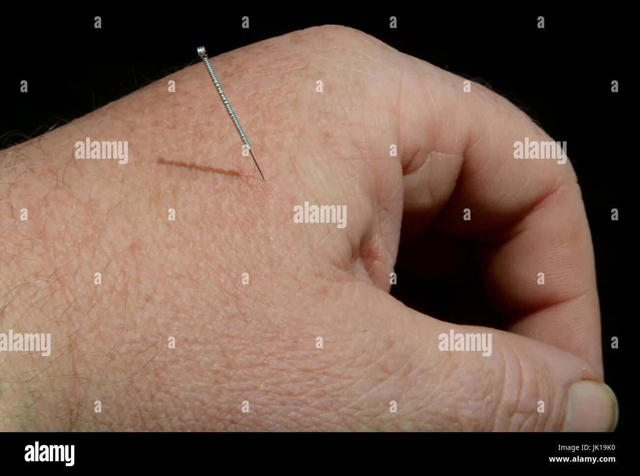 Avec la main de l'aiguille d'acupuncture. Banque D'Images