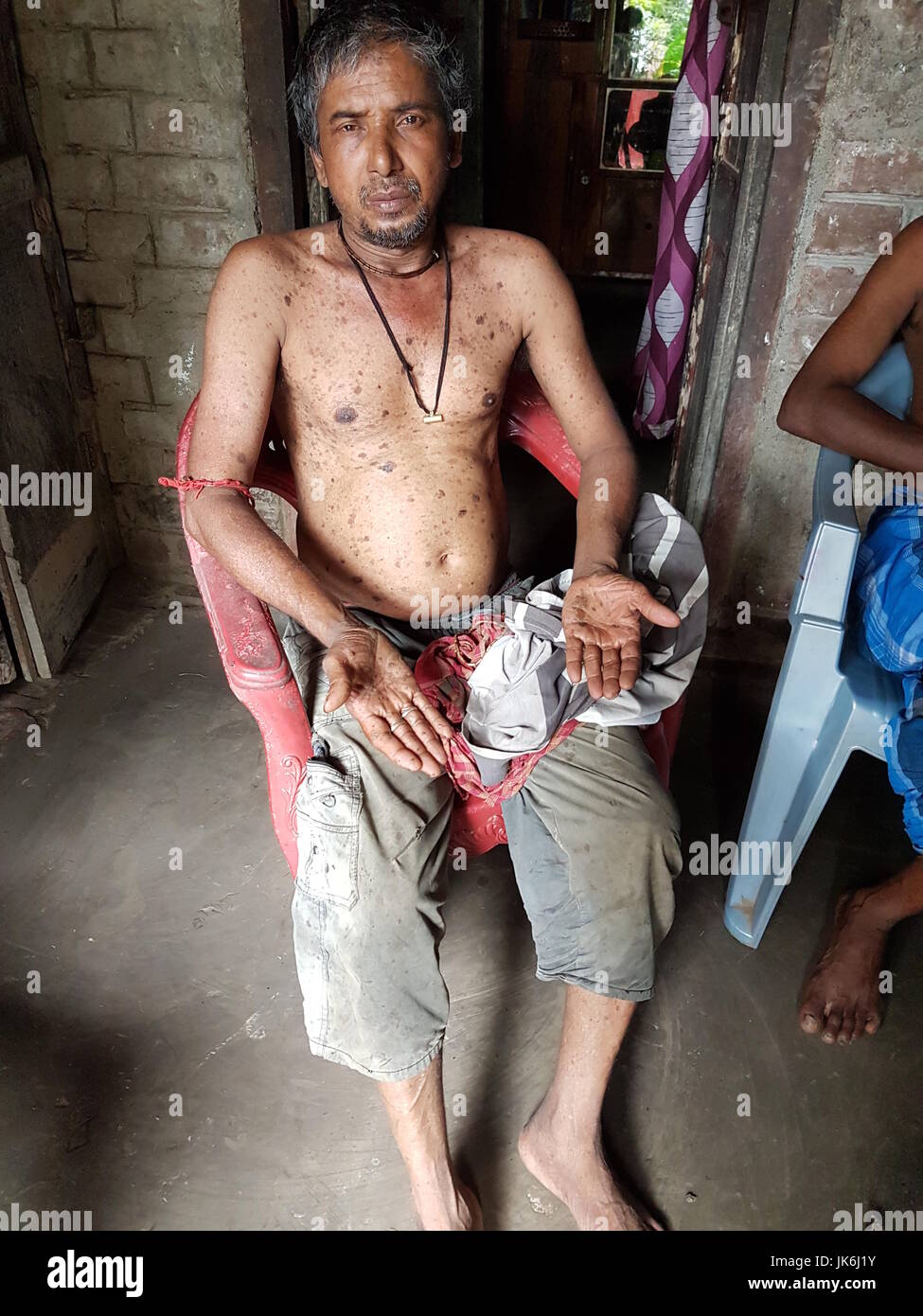 Sribas Pal est assis sur la véranda de sa maison en Kolsur dans Inida, 13 juillet 2017. Il souffre des effets de la consommation d'arsenic. Dans le domaine de l'eau est contaminée par le poison. Mai des millions de personnes en Inde et au Bangladesh n'ont pas accès à l'eau potable. Photo : Nick Kaiser/dpa Banque D'Images