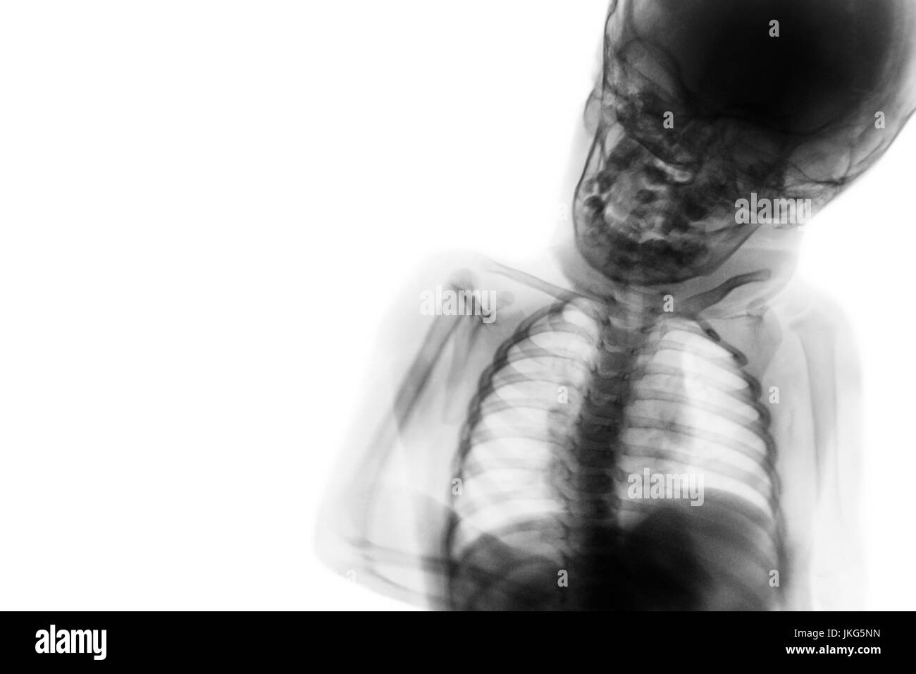 X-ray la moitié du corps de l'enfant et la zone vide du côté gauche . Banque D'Images