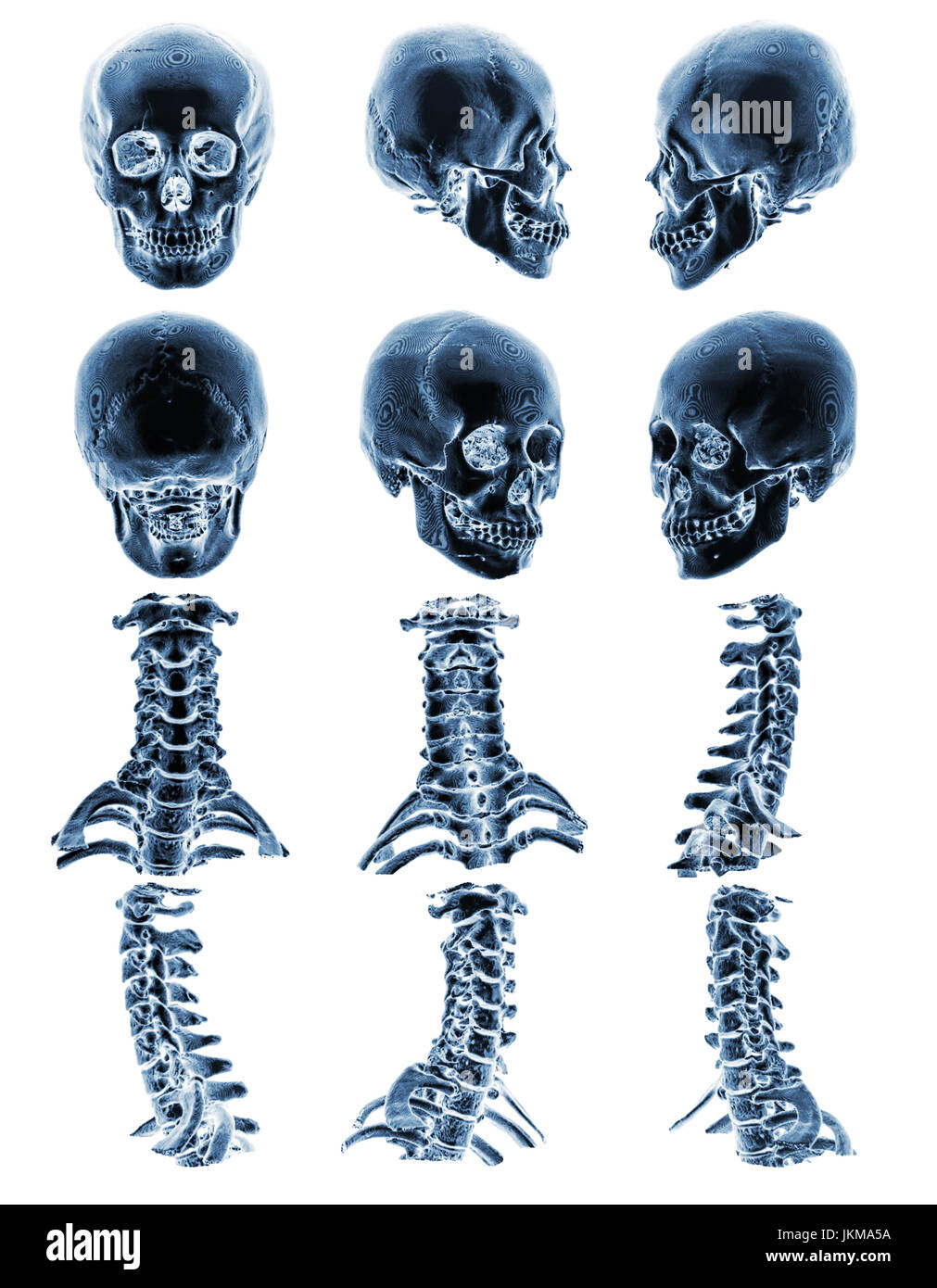 Tomodensitométrie La tomodensitométrie ( ) avec 3D, crâne humain normal et rachis cervical . Plusieurs avis . Banque D'Images