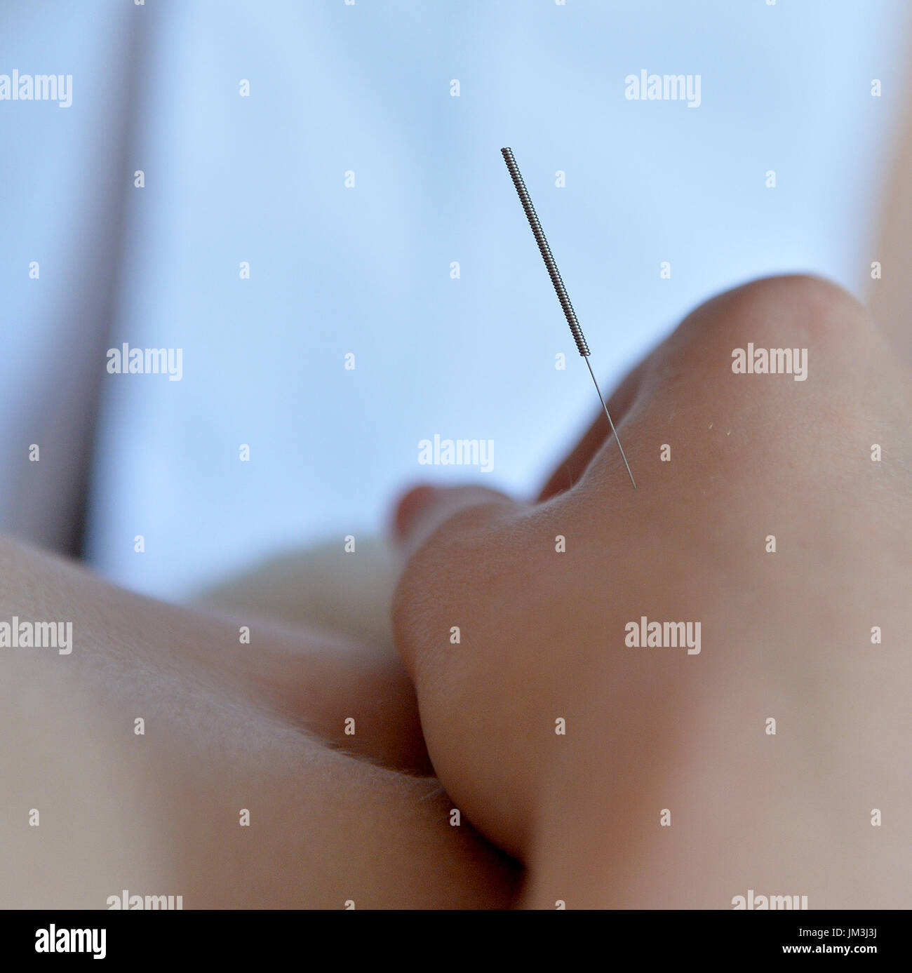 Un traitement d'acupuncture photo en gros plan d'un traitement d'acupuncture photo en gros plan Banque D'Images