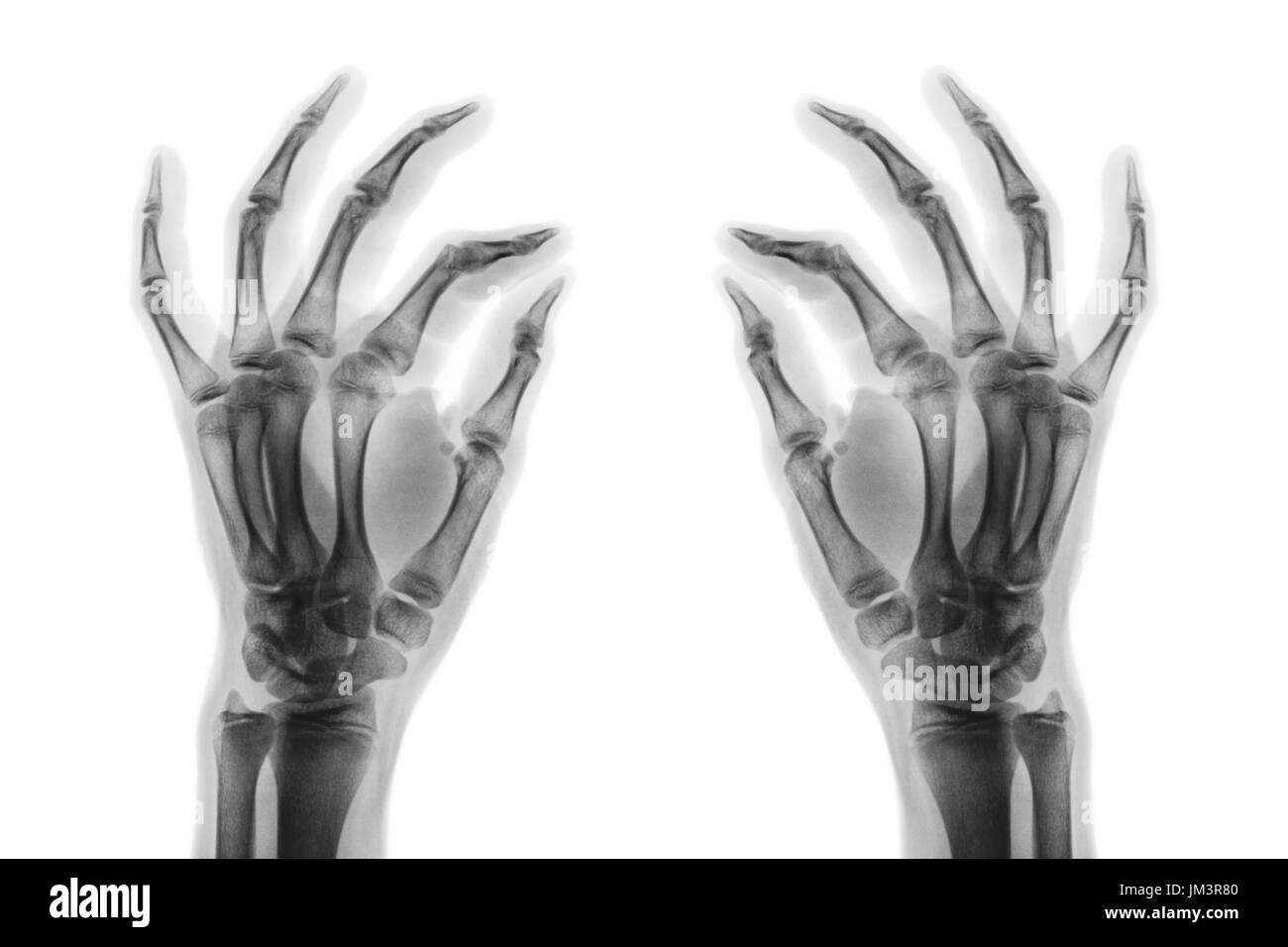 X-ray mains humaines normales sur fond blanc . Vue oblique . Banque D'Images