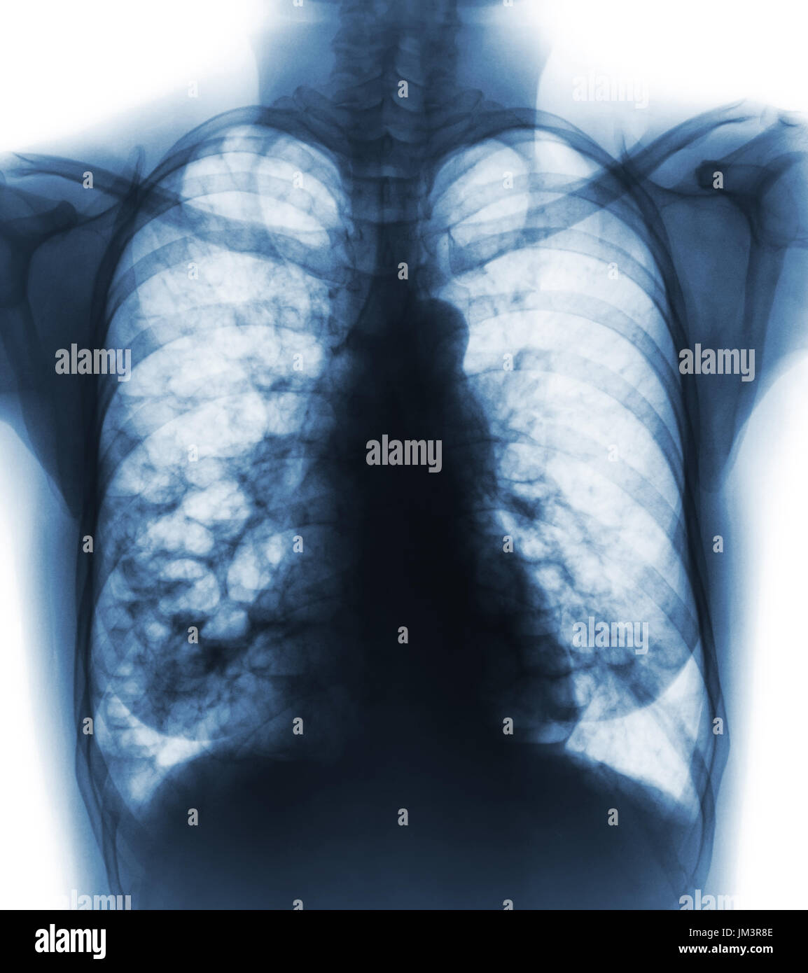 La bronchiectasie . X-ray poitrine afficher de multiples kystes pulmonaires bleb et en raison de l'infection chronique . Vue de face . Banque D'Images
